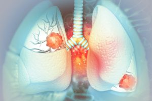 iza-bren-receives-fda-breakthrough-therapy-designation-for-egfr-mutated-nsclc