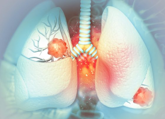 iza-bren-receives-fda-breakthrough-therapy-designation-for-egfr-mutated-nsclc