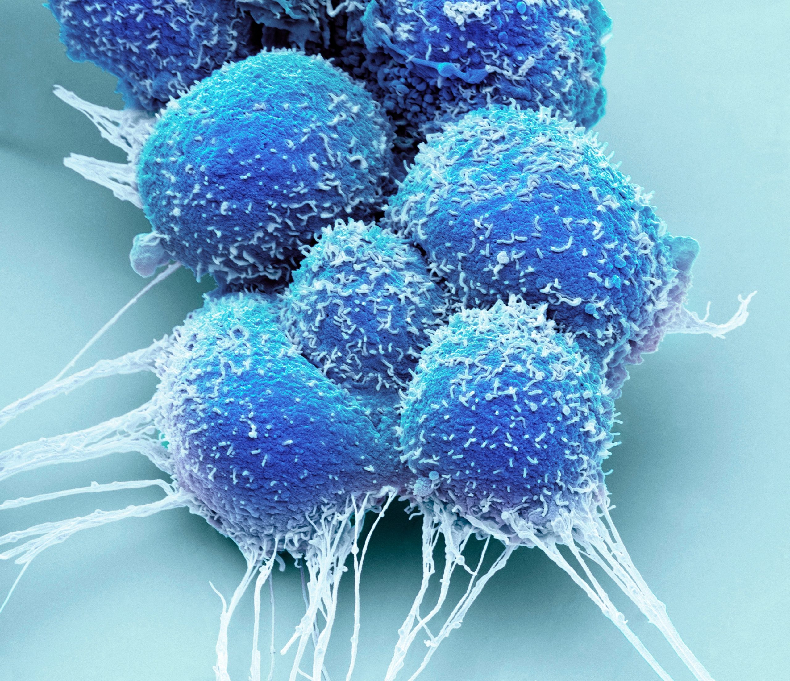 FDA Approves 3-Month Leuprolide Mesylate 21 mg Formulation for Advanced Prostate Cancer