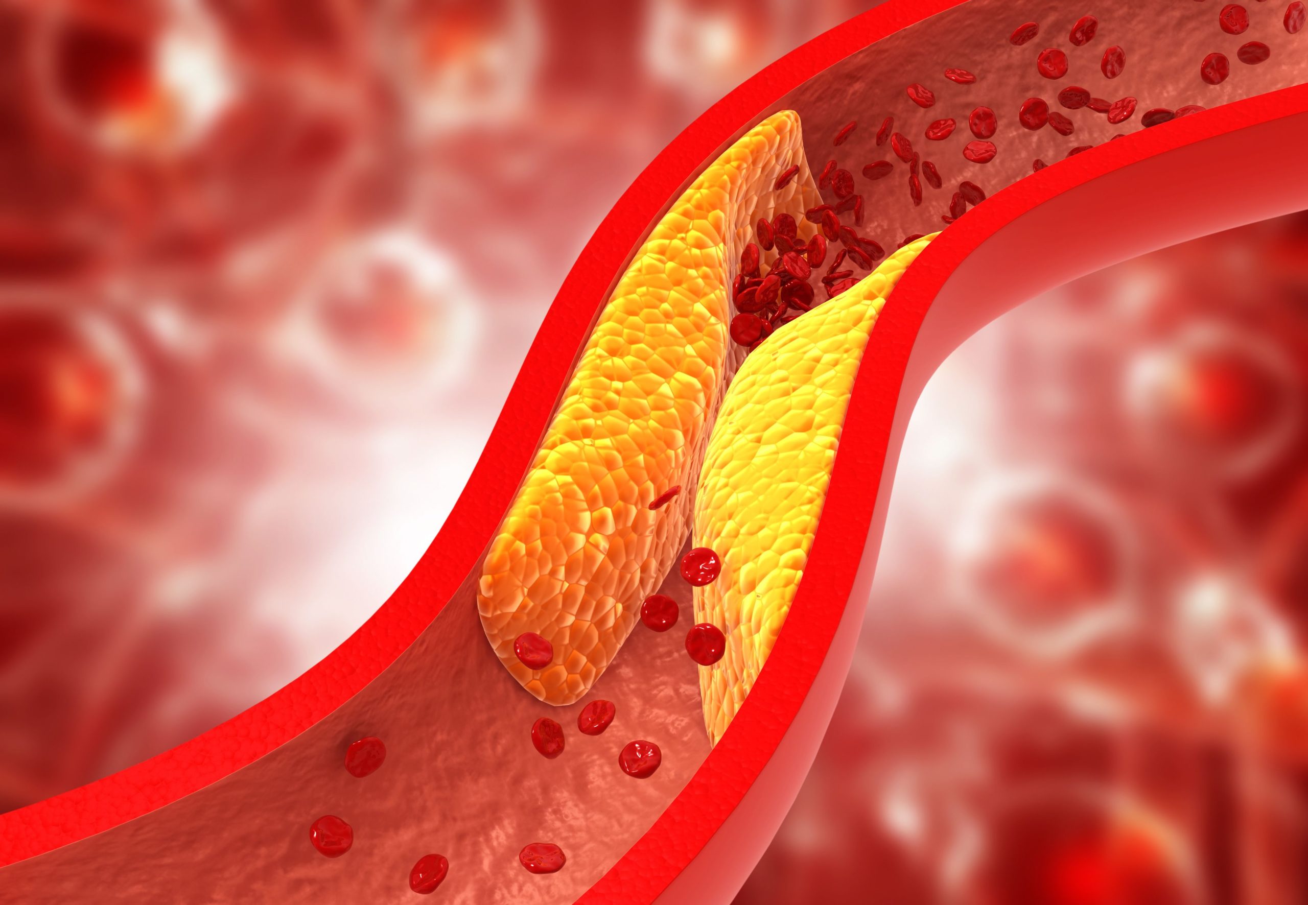 Enlicitide Offers a New Oral Option for Managing High Cholesterol