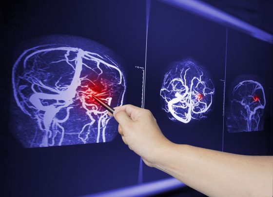 moderate-to-severe-tbi-linked-to-elevated-risk-of-malignant-brain-tumors