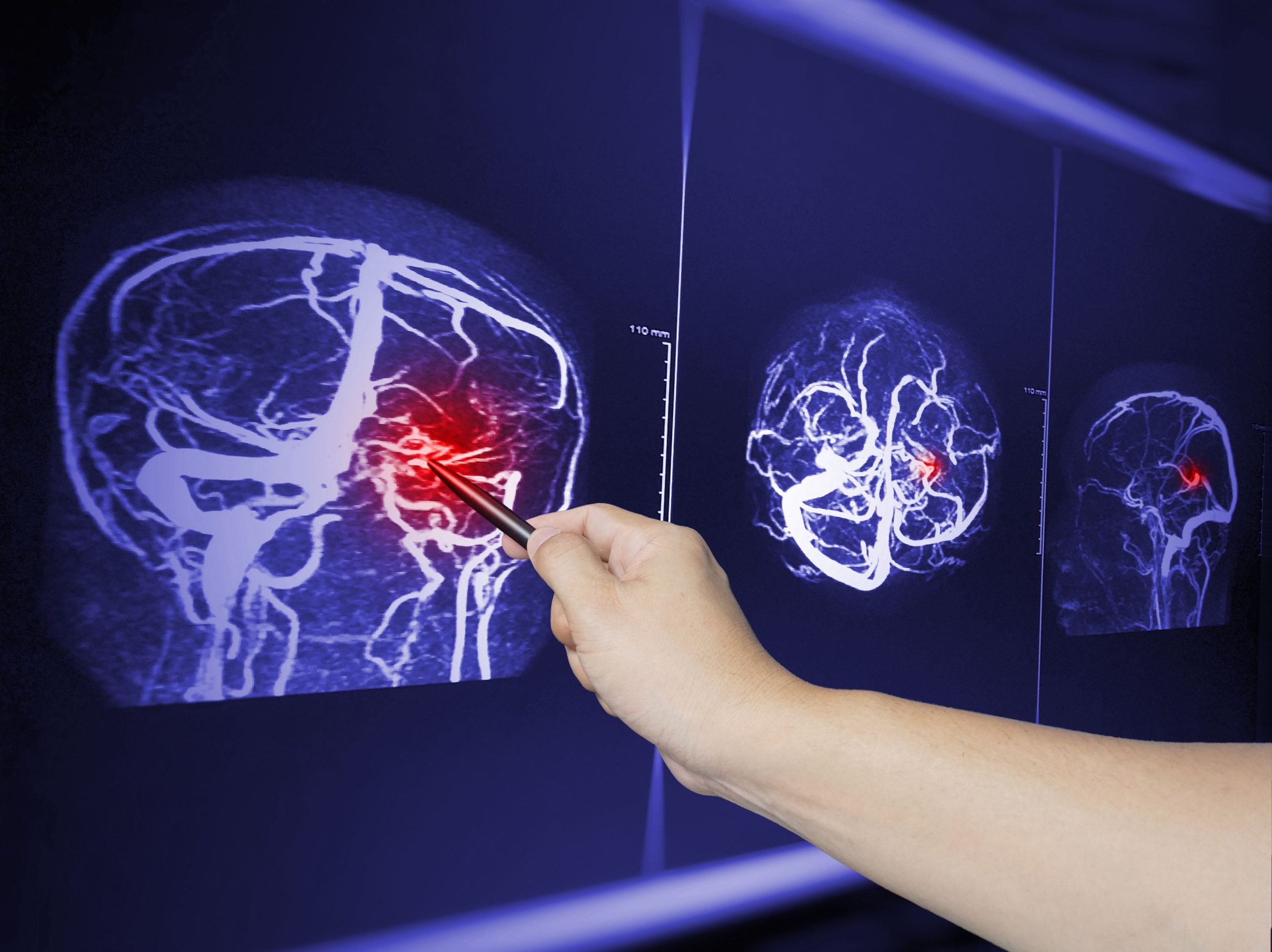 Moderate-to-Severe TBI Linked to Elevated Risk of Malignant Brain Tumors