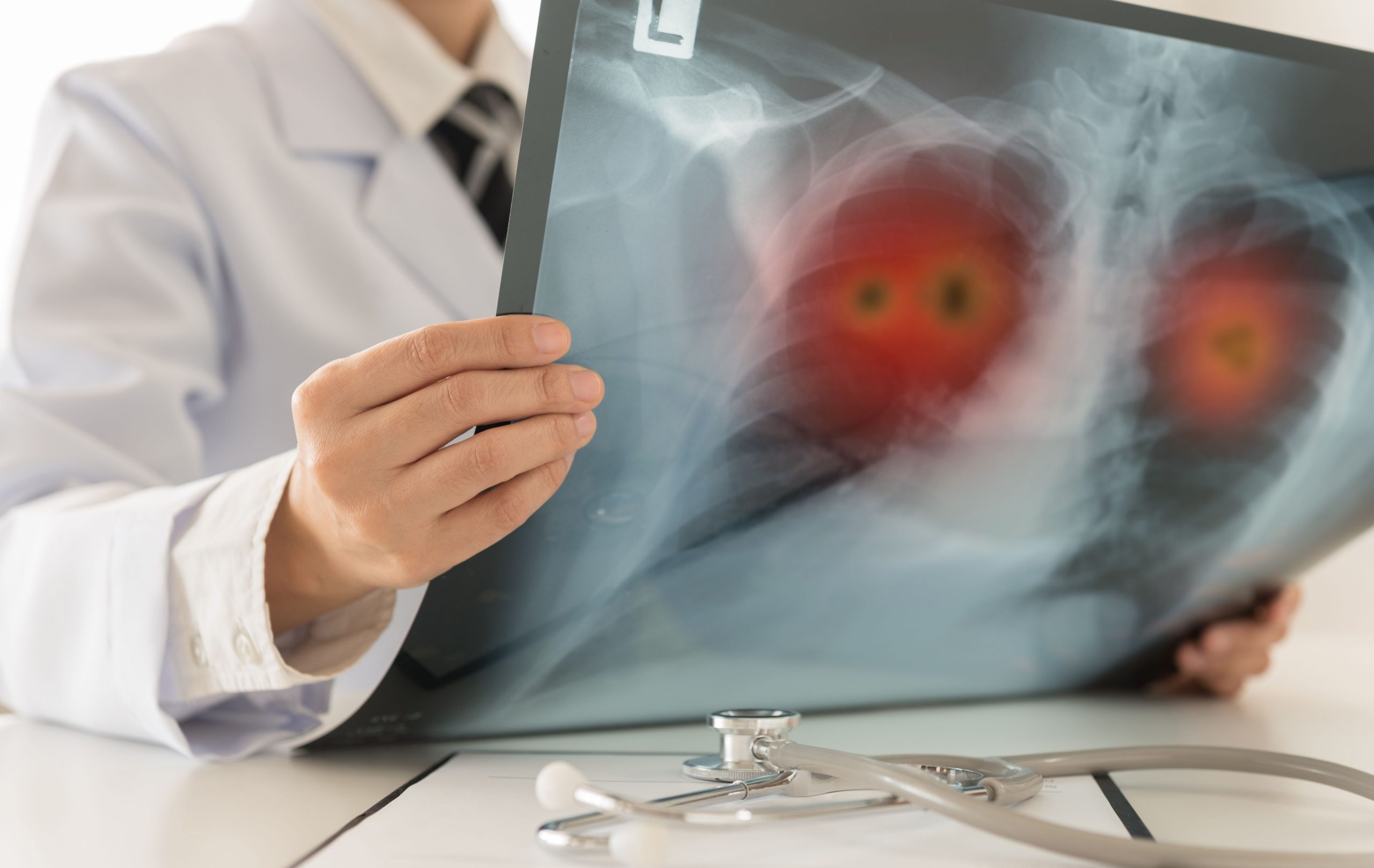 FDA Grants Breakthrough Therapy Designation to Olomorasib With Pembrolizumab for NSCLC