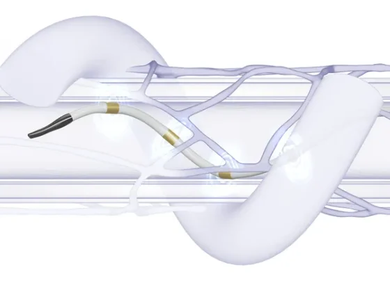renal-denervation-gets-strong-backing-from-cardiologists-ahead-of-medicare-coverage-decision
