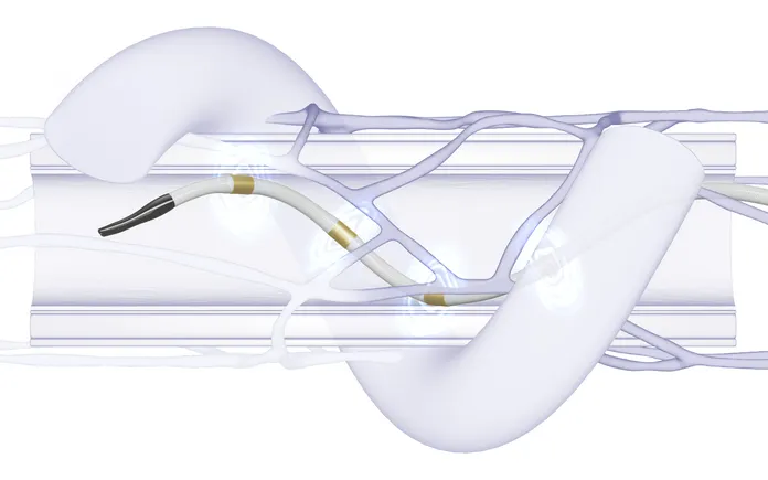 Renal denervation gets strong backing from cardiologists ahead of Medicare coverage decision