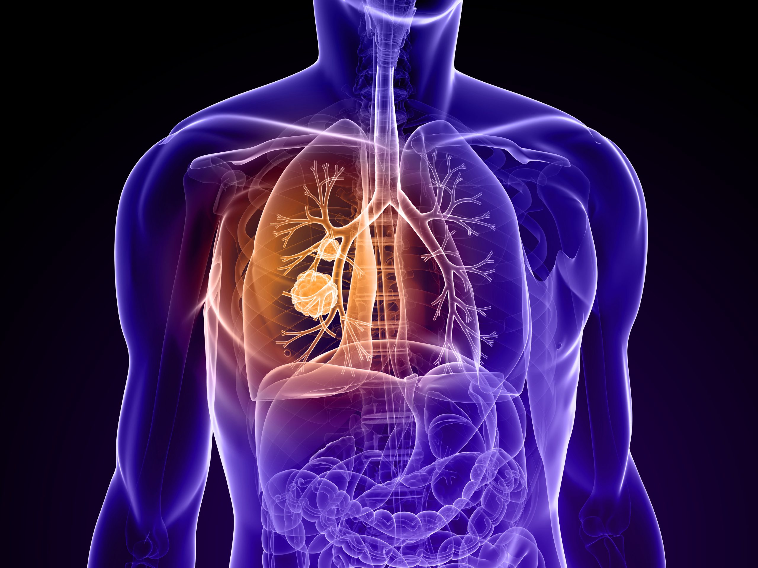 Zidesamtinib Shows Clinically Meaningful Activity, Durability in ROS1+ NSCLC