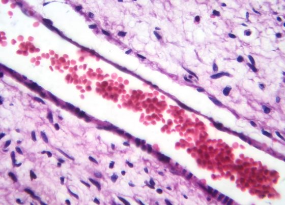 fda-expands-selumetinib-to-children-with-nf1-associated-plexiform-neurofibromas