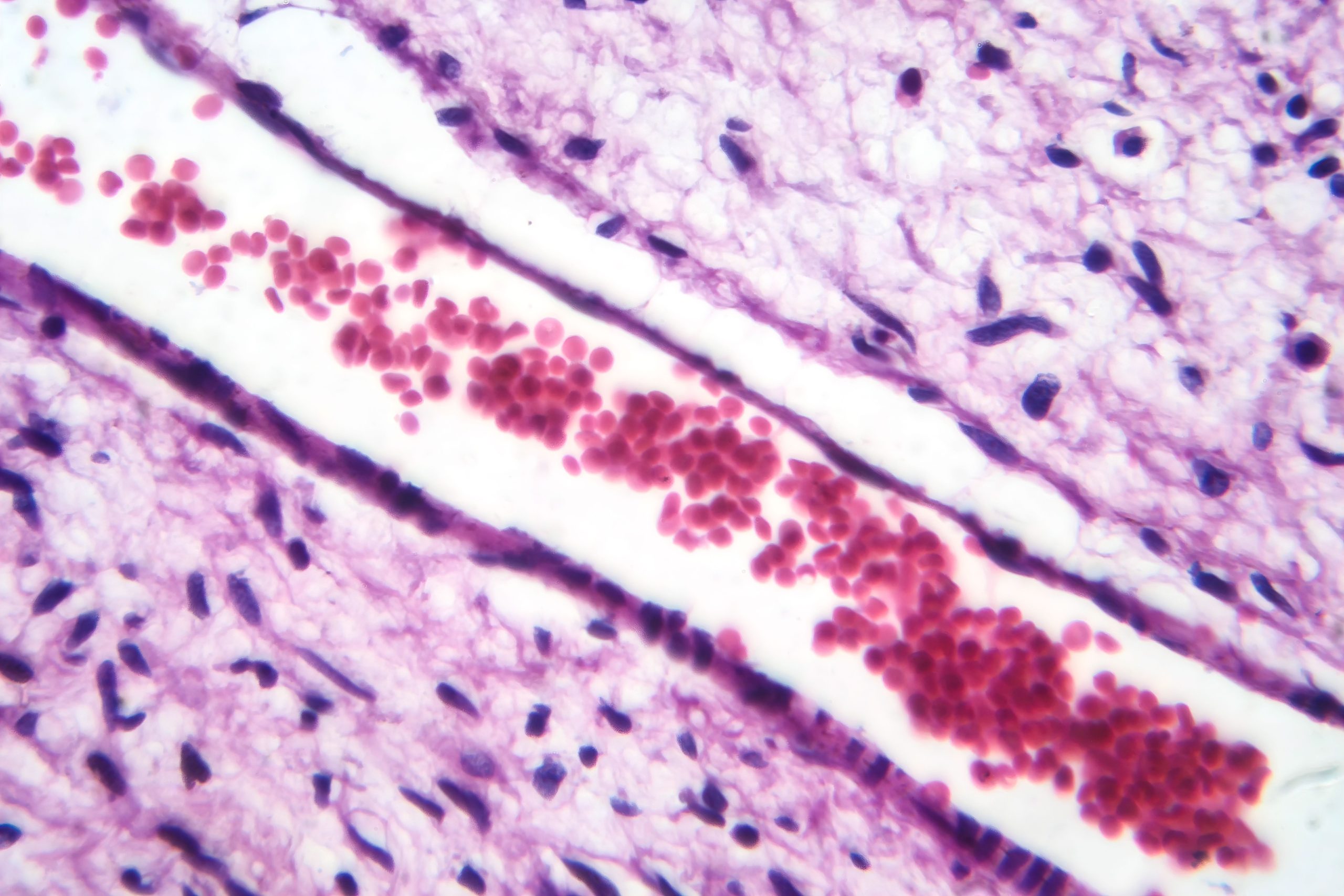 FDA Expands Selumetinib to Children With NF1-Associated Plexiform Neurofibromas