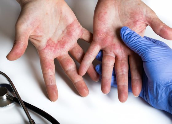 amlitelimab-meaningfully-clears-skin-in-moderate-to-severe-atopic-dermatitis