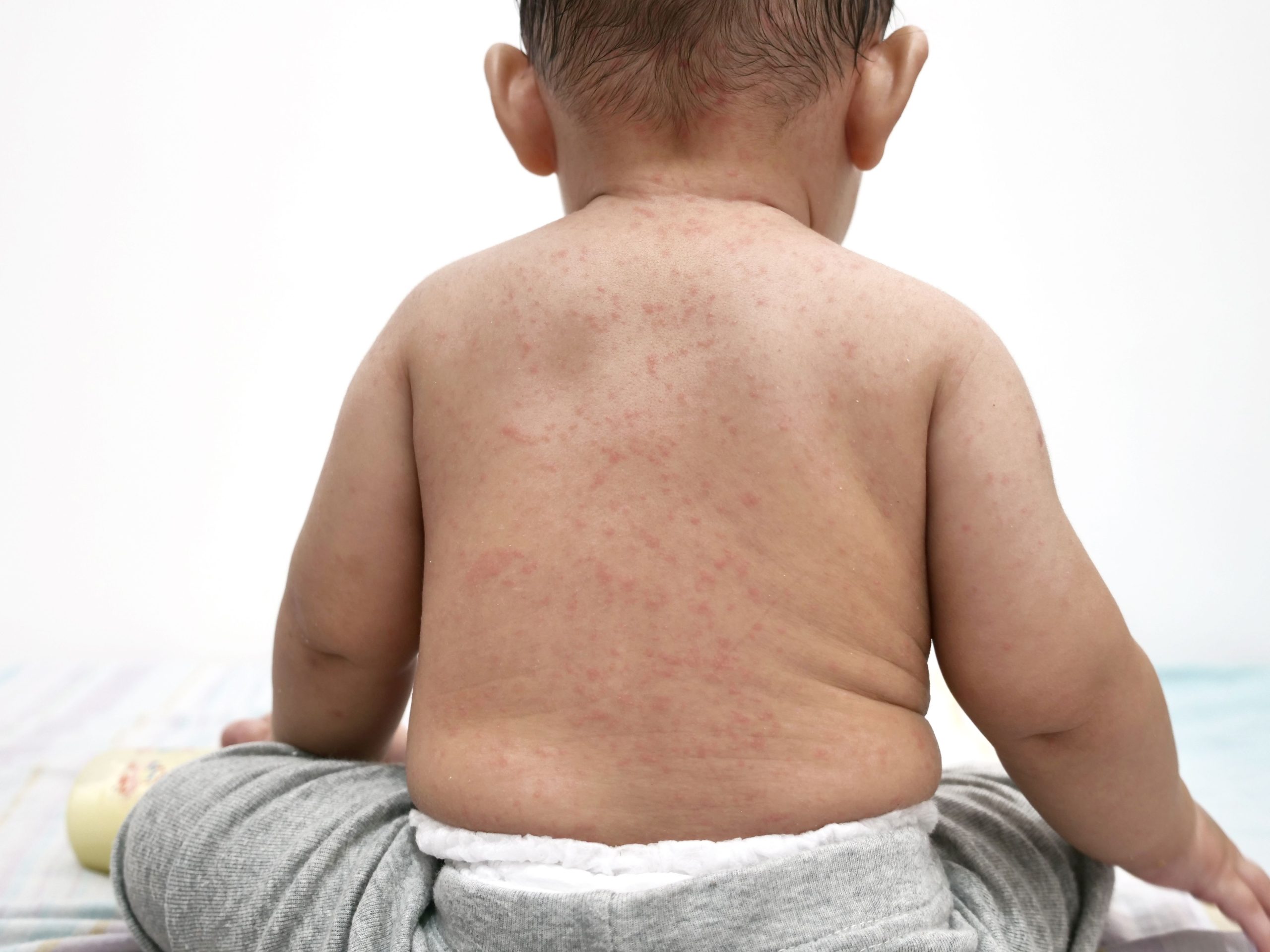 Los Angeles Reports Fatal Case of a Rare Measles Complication Years After Infection