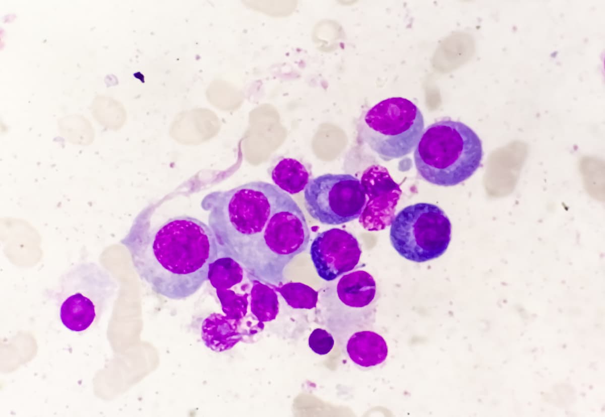 <![CDATA[Linvoseltamab Monotherapy Elicits Promising ORR, MRD-Negativity in NDMM]]>