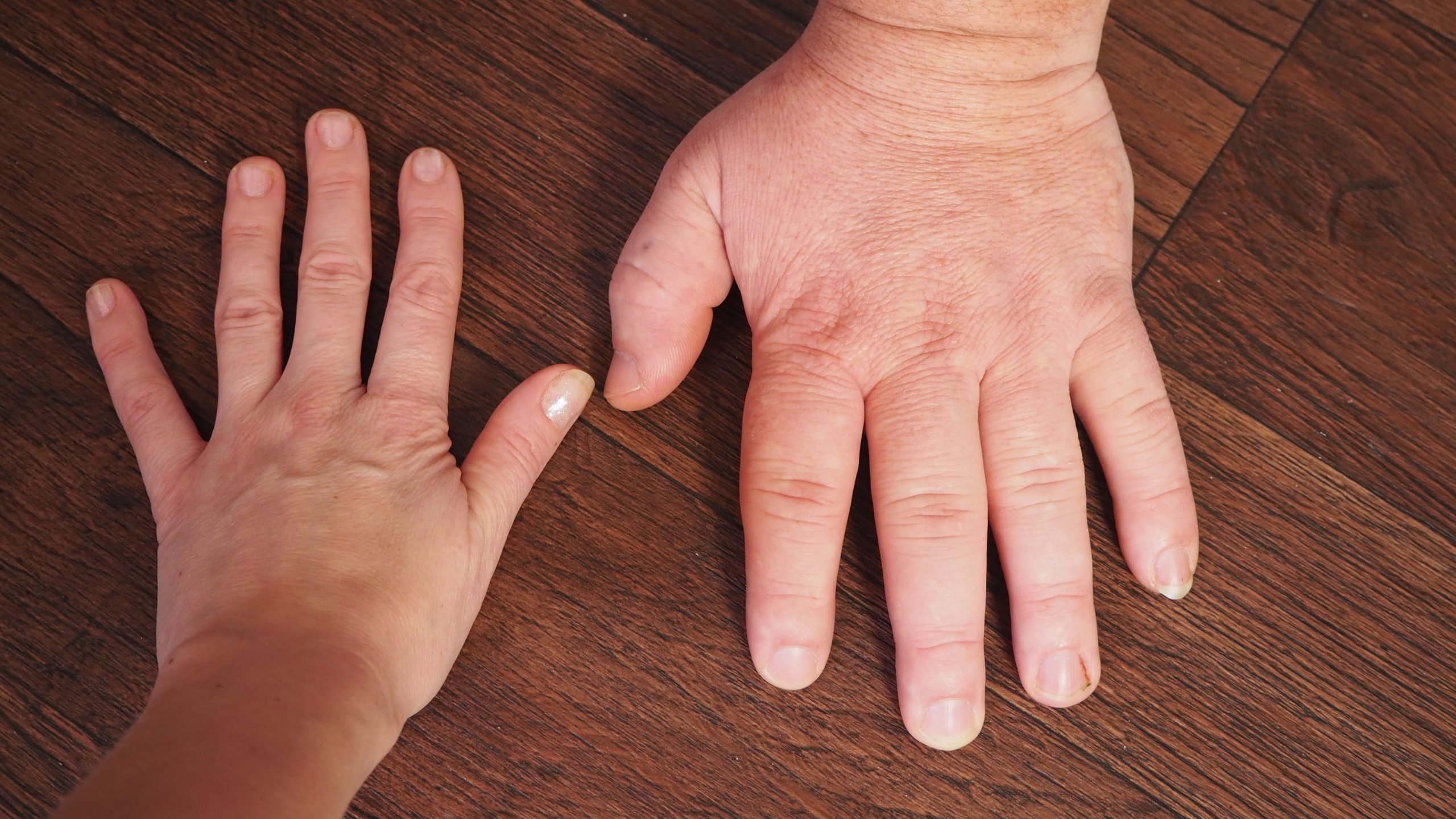 <![CDATA[Paltusotine Receives FDA Approval to Treat Acromegaly in Adults]]>