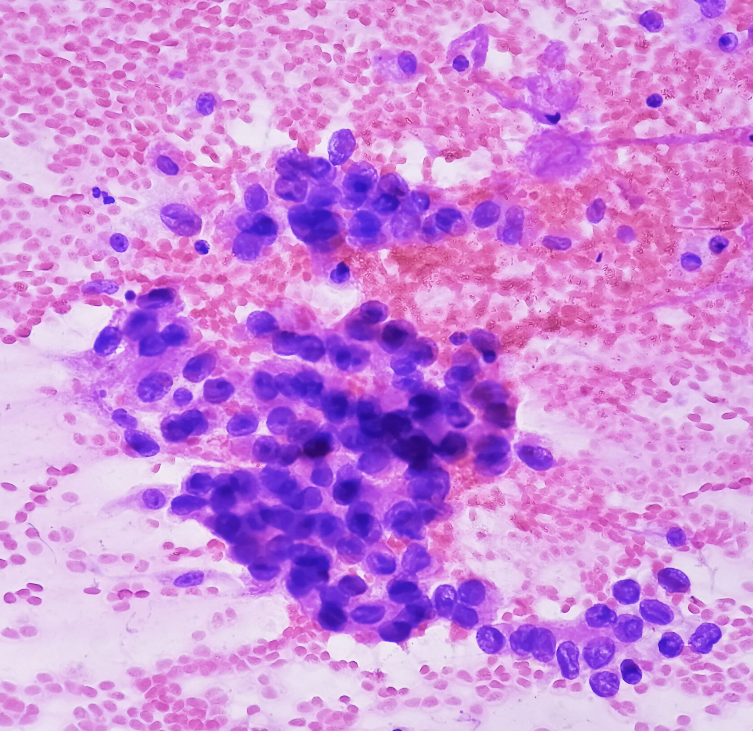 <![CDATA[Pumitamig Shows Positive Trend in PFS Treating Patients With ES-SCLC]]>