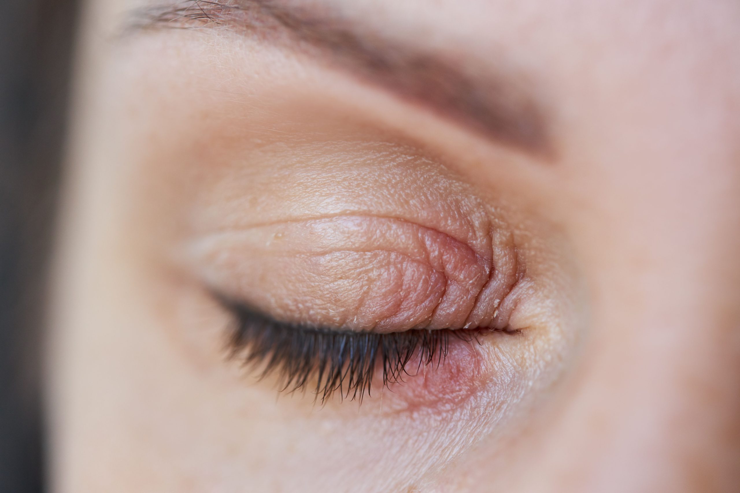<![CDATA[Lotilaner a Breakthrough Drug in Demodex Blepharitis Treatment]]>