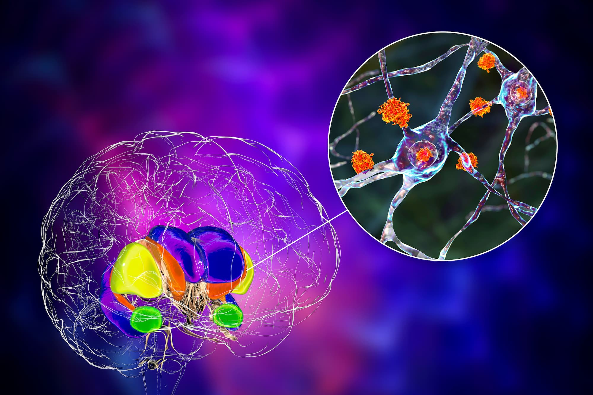 <![CDATA[Novel Gene Therapy Significantly Slows Progression of Huntington Disease]]>