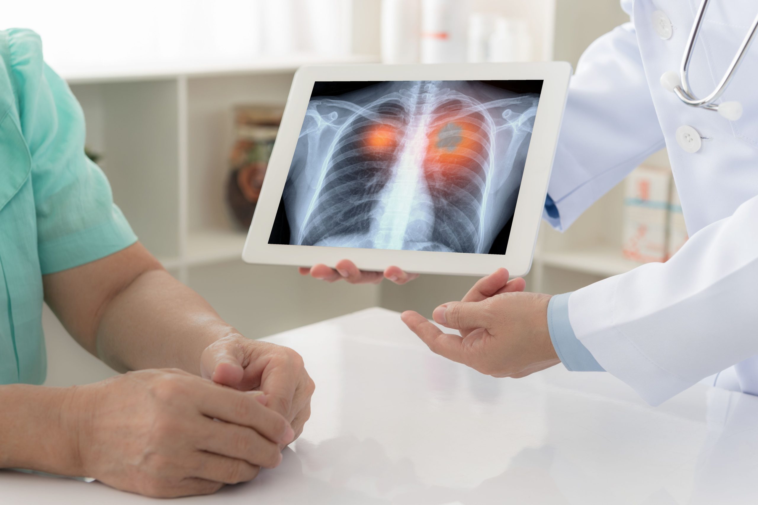 <![CDATA[SABR Overall Survival Noninferior to Surgery in Patients With Early NSCLC]]>