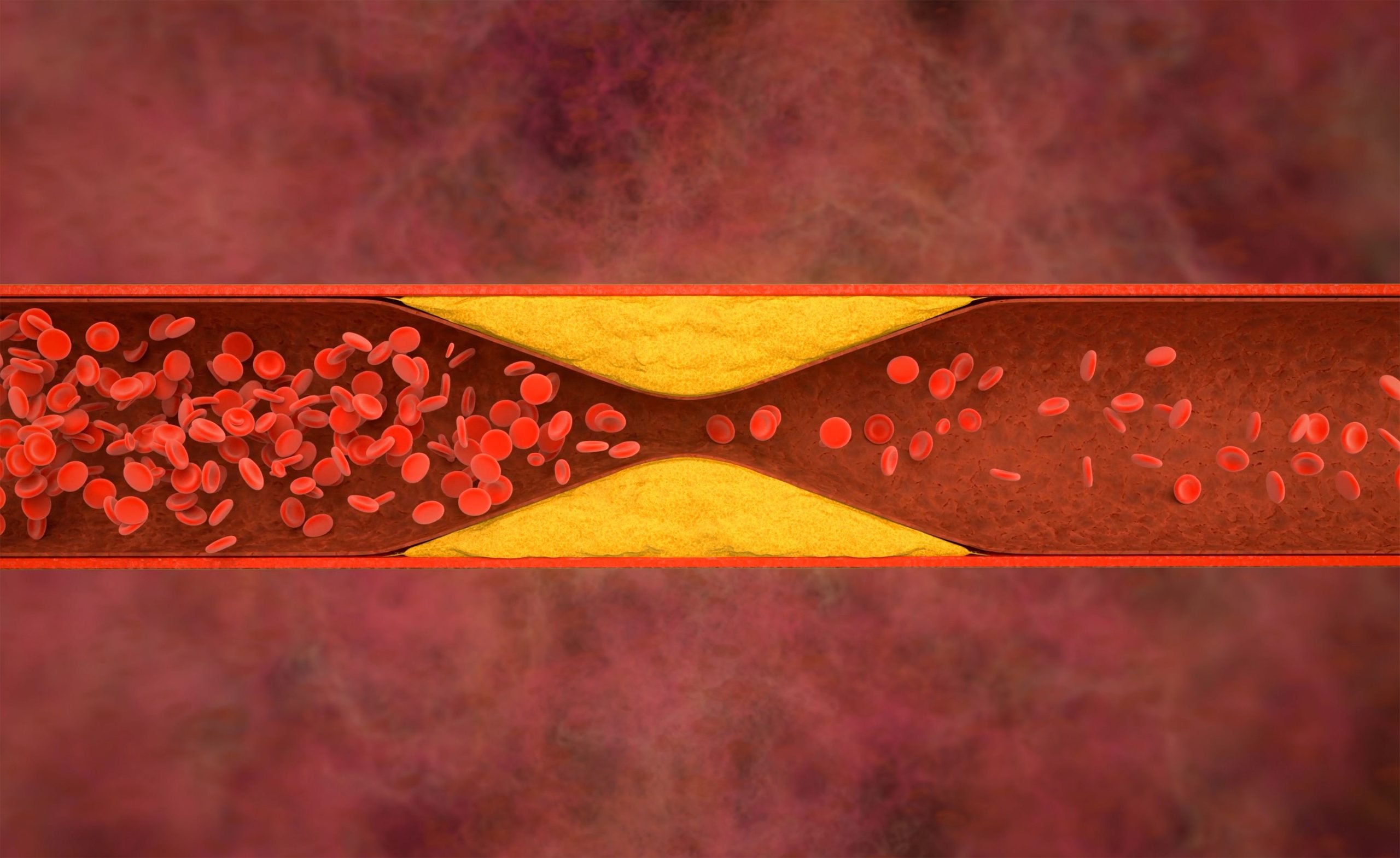 <![CDATA[Evinacumab-dgnb Approved For Children Aged 1-5 With Rare Form of High Cholesterol]]>