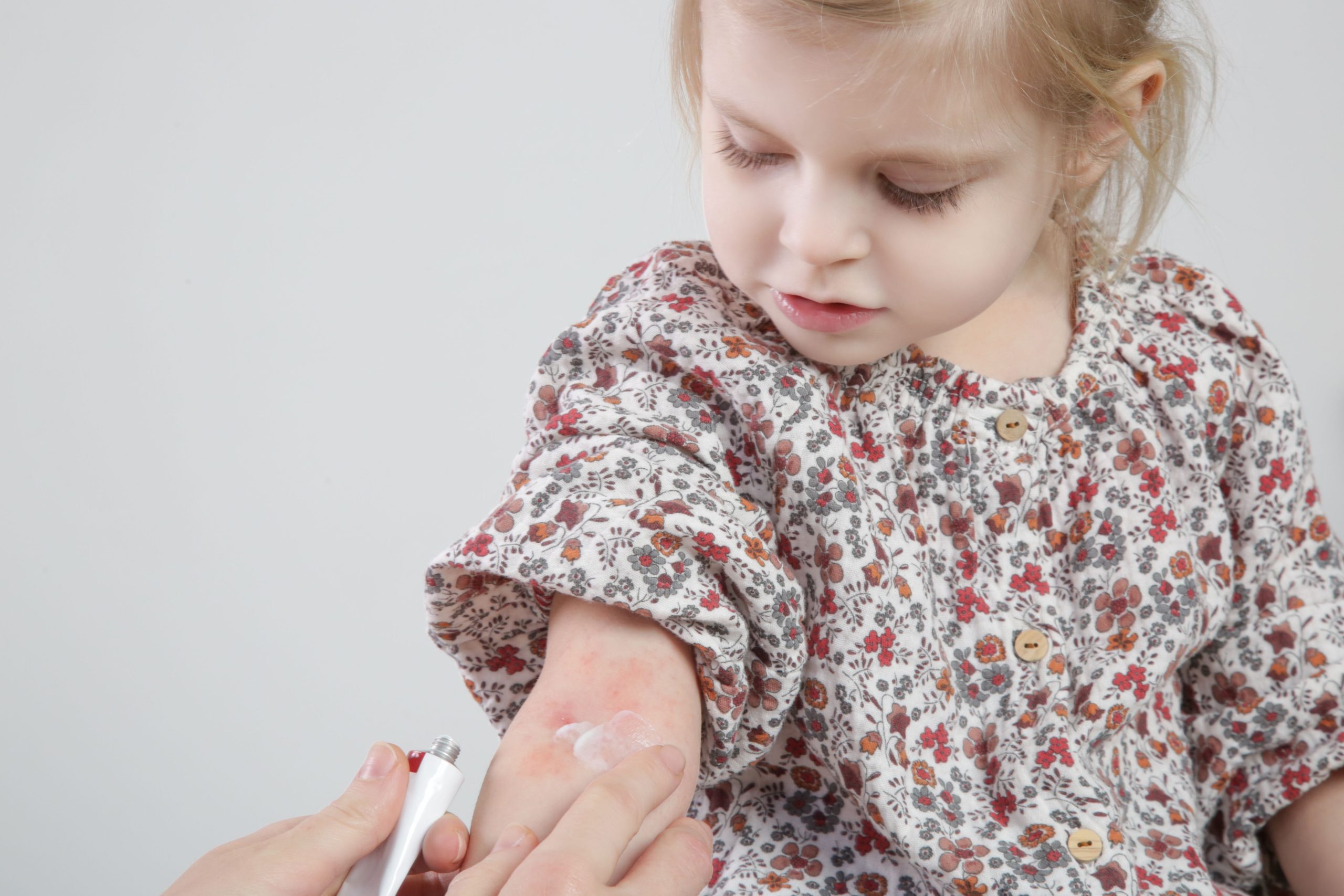 <![CDATA[FDA Approves Roflumilast Cream for Pediatric Patients With Atopic Dermatitis]]>