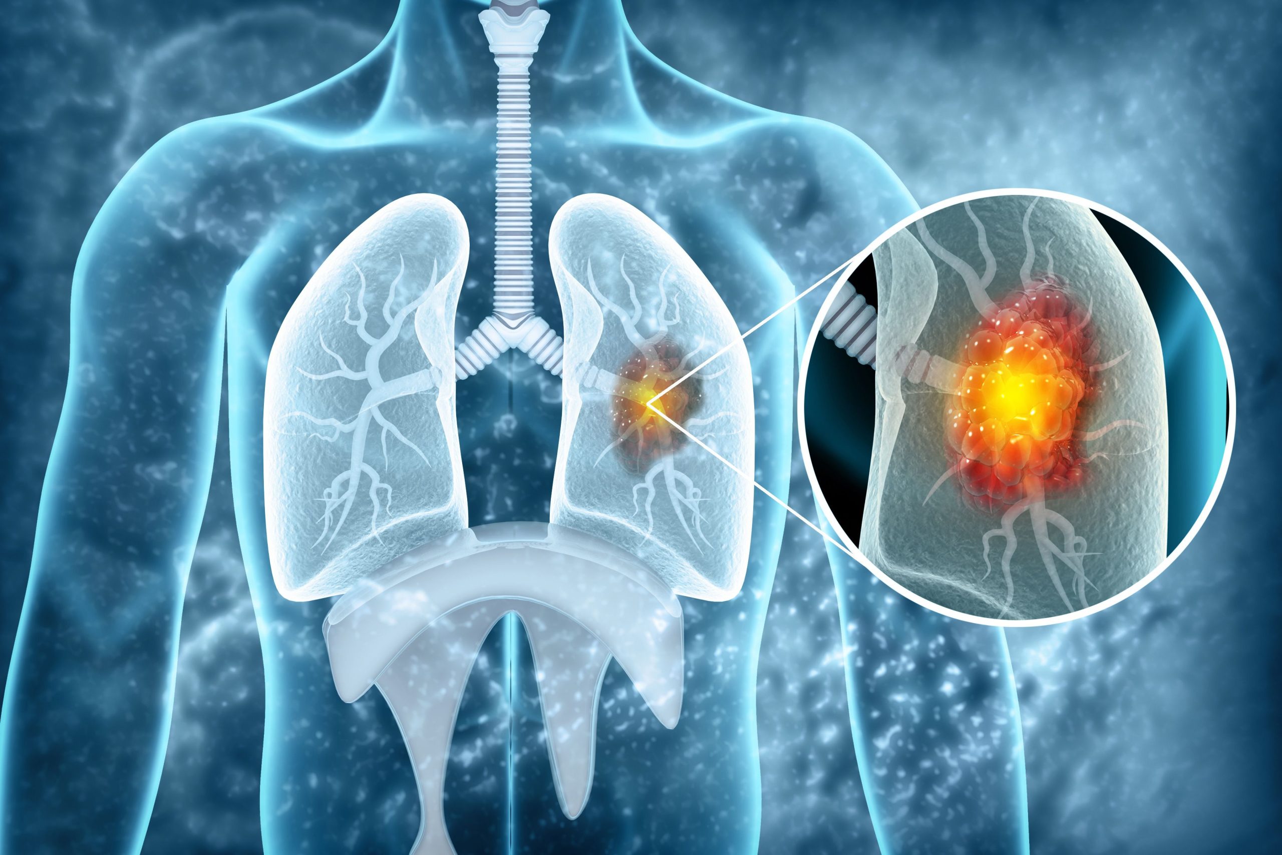 <![CDATA[Aumolertinib and Osimertinib Demonstrate Comparable Outcomes in EGFR-Mutated NSCLC]]>