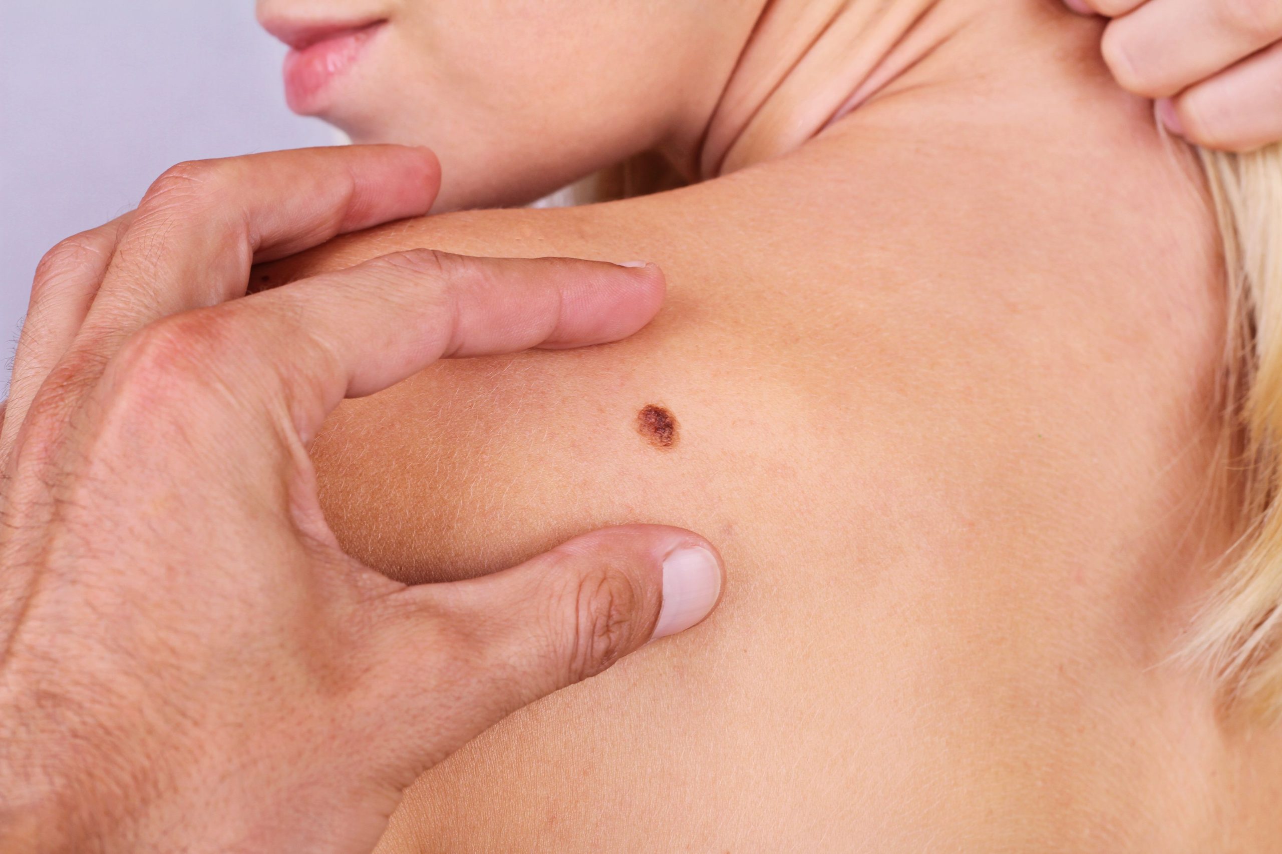 <![CDATA[FDA Approves Cemiplimab as Adjuvant Treatment for Cutaneous Squamous Cell Carcinoma]]>