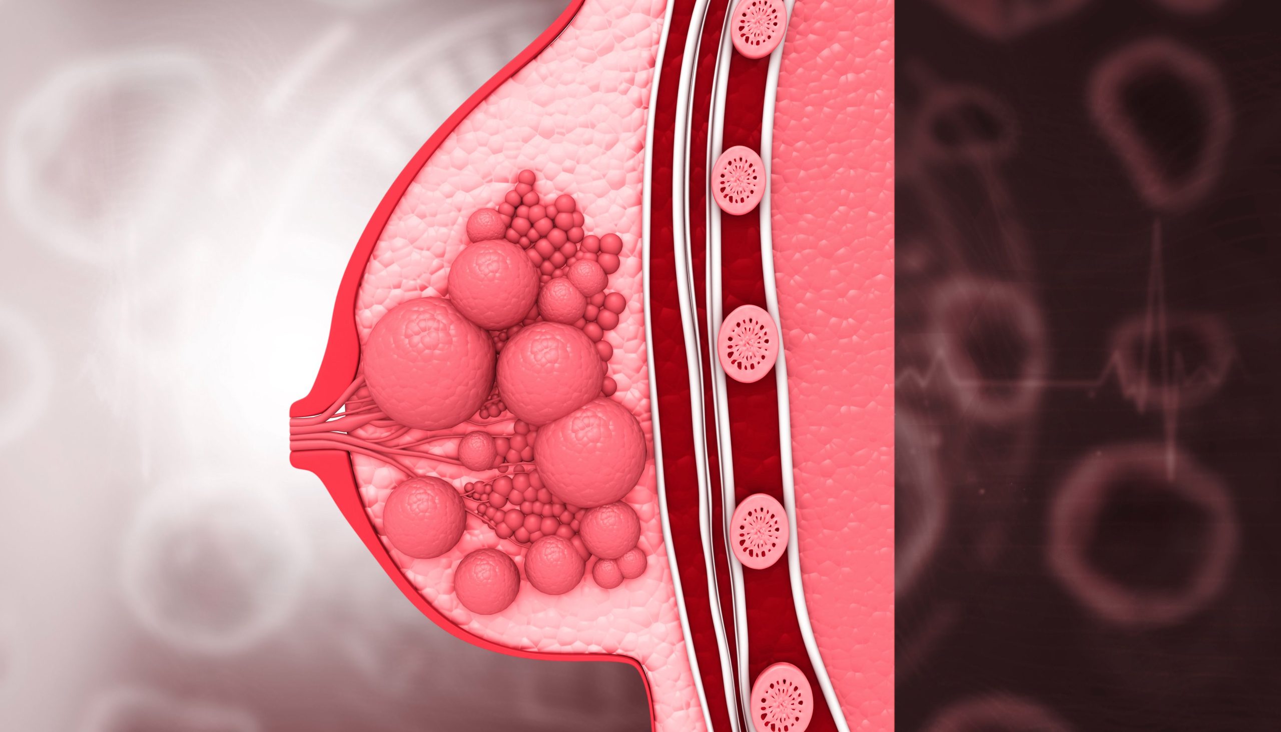 <![CDATA[New Report Details Rising Incidence of Invasive Lobular Carcinoma]]>
