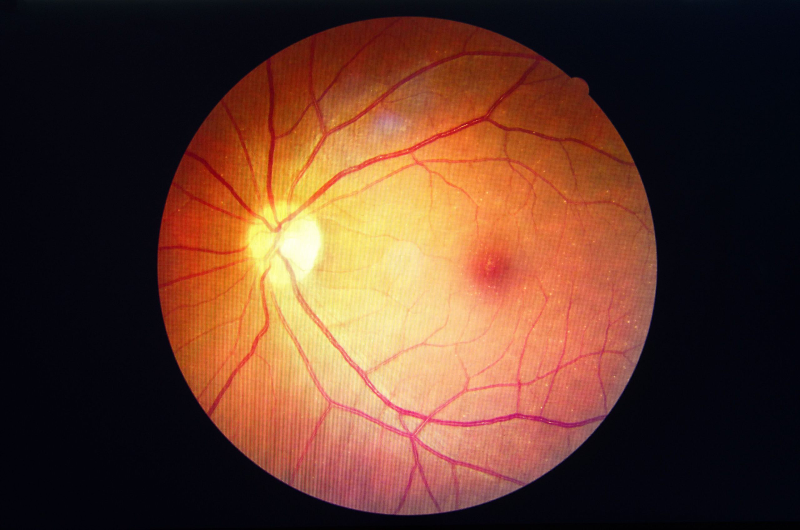 <![CDATA[FDA Approves Celltrion’s Eydenzelt, Biosimilar to Aflibercept, to Treat Ocular Conditions]]>