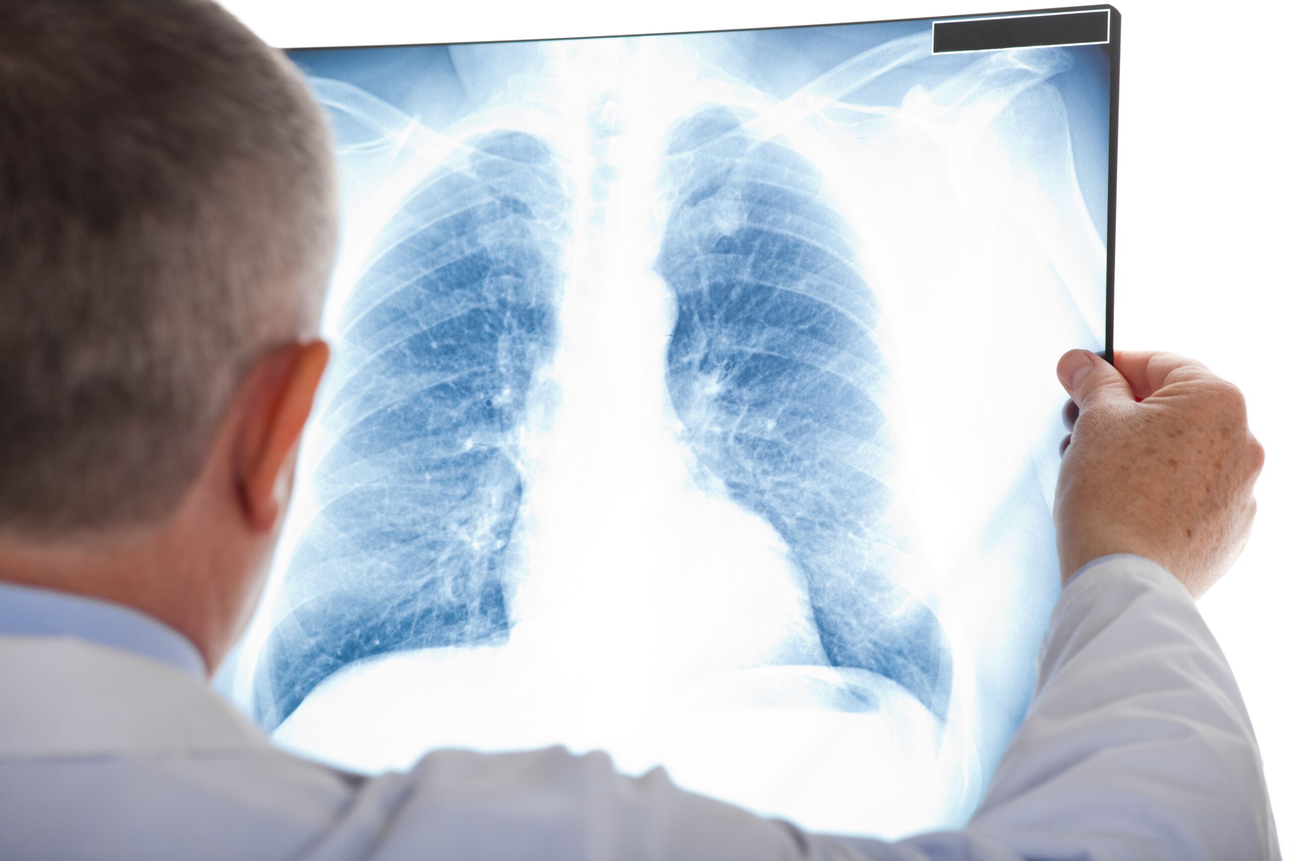 <![CDATA[TACTI-004 Trial Studying Eftilagimod Alfa With Pembrolizumab in Advanced NSCLC to Begin Evaluation]]>