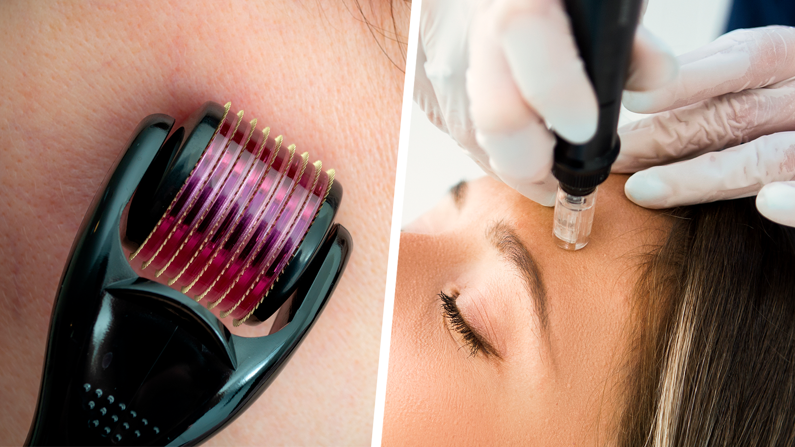 Microneedling Devices: Getting to the Point on Benefits, Risks and Safety