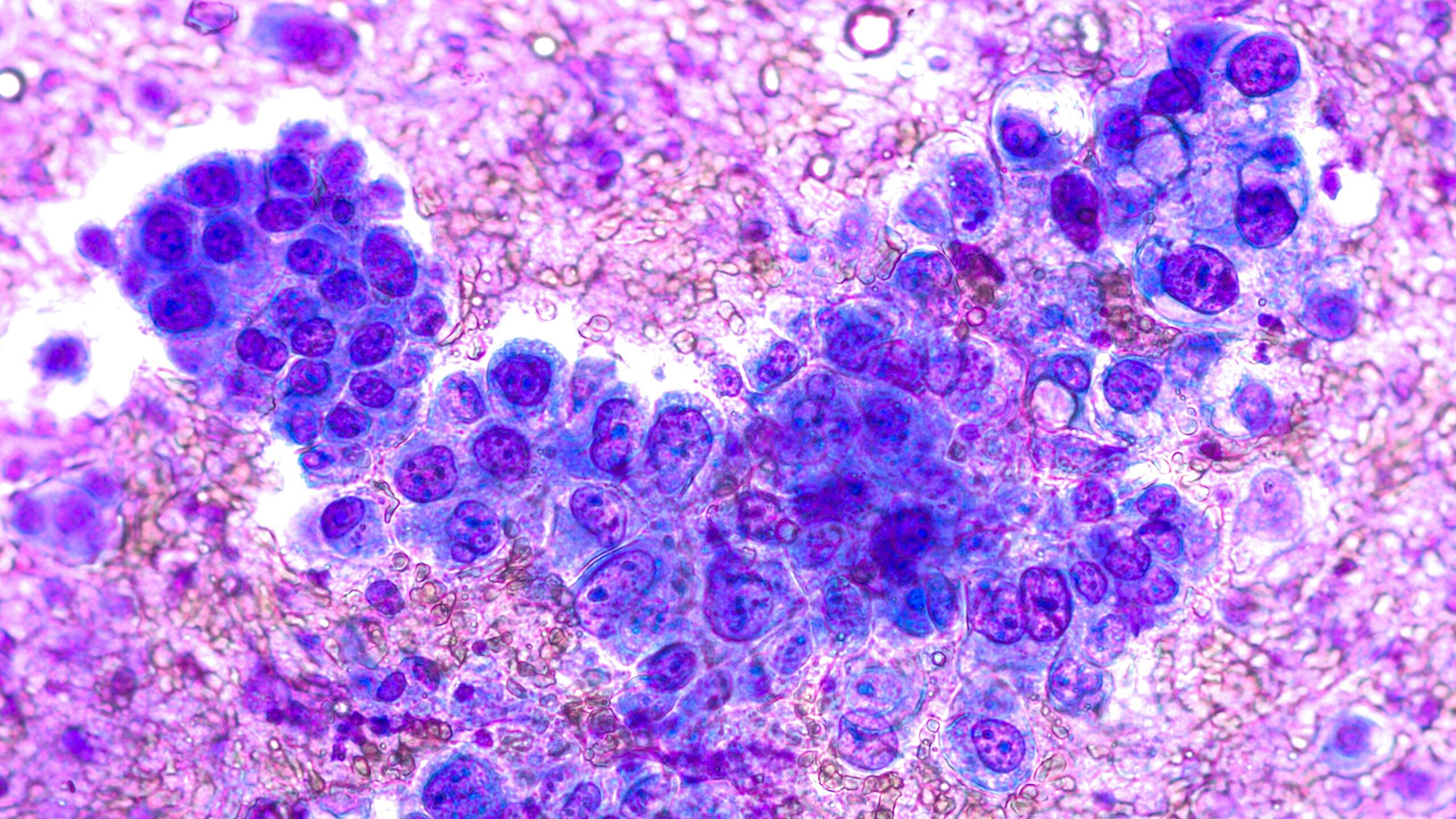 <![CDATA[Amivantamab for EGFR-Mutated Metastatic Non–Small Cell Lung Cancer]]>