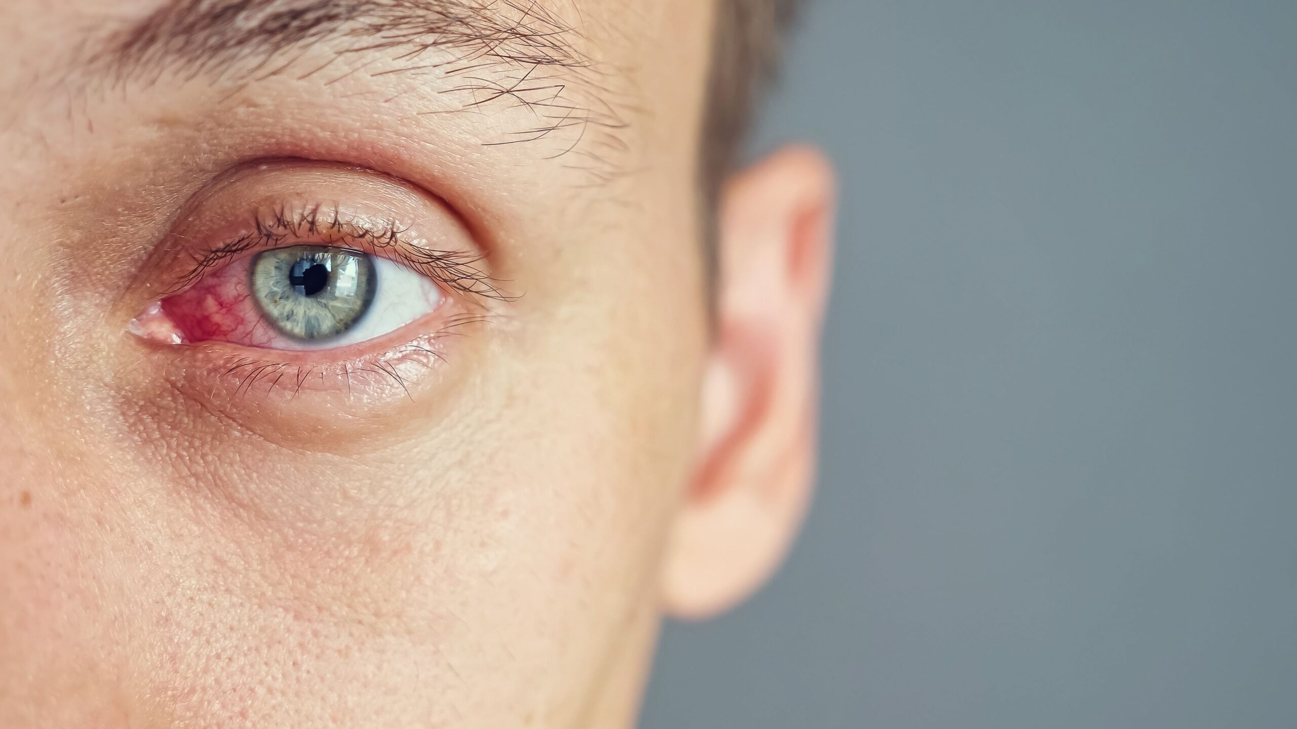 <![CDATA[OTC Case Studies: Dry Eye]]>