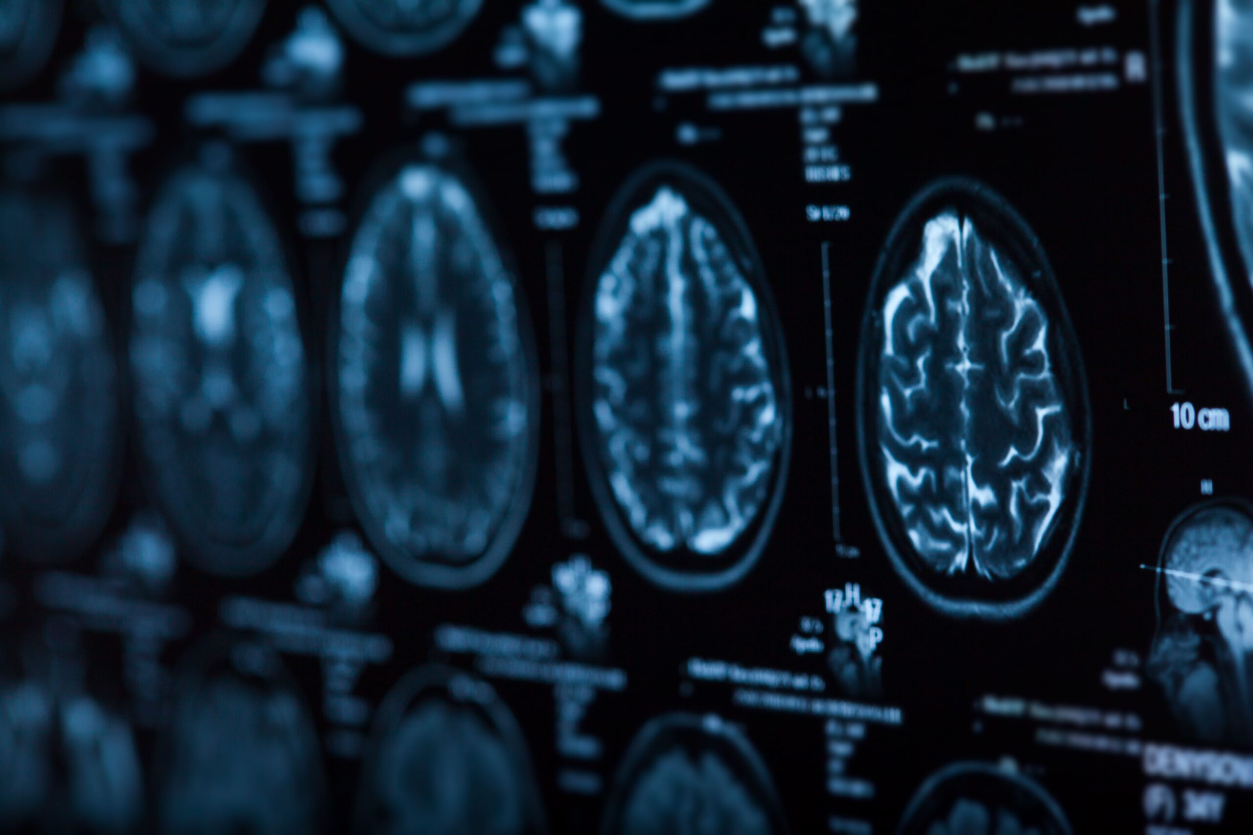 <![CDATA[Earlier Menopause, Reduced Cardiac Function Potentially Linked With Negative Impacts on Brain Health]]>