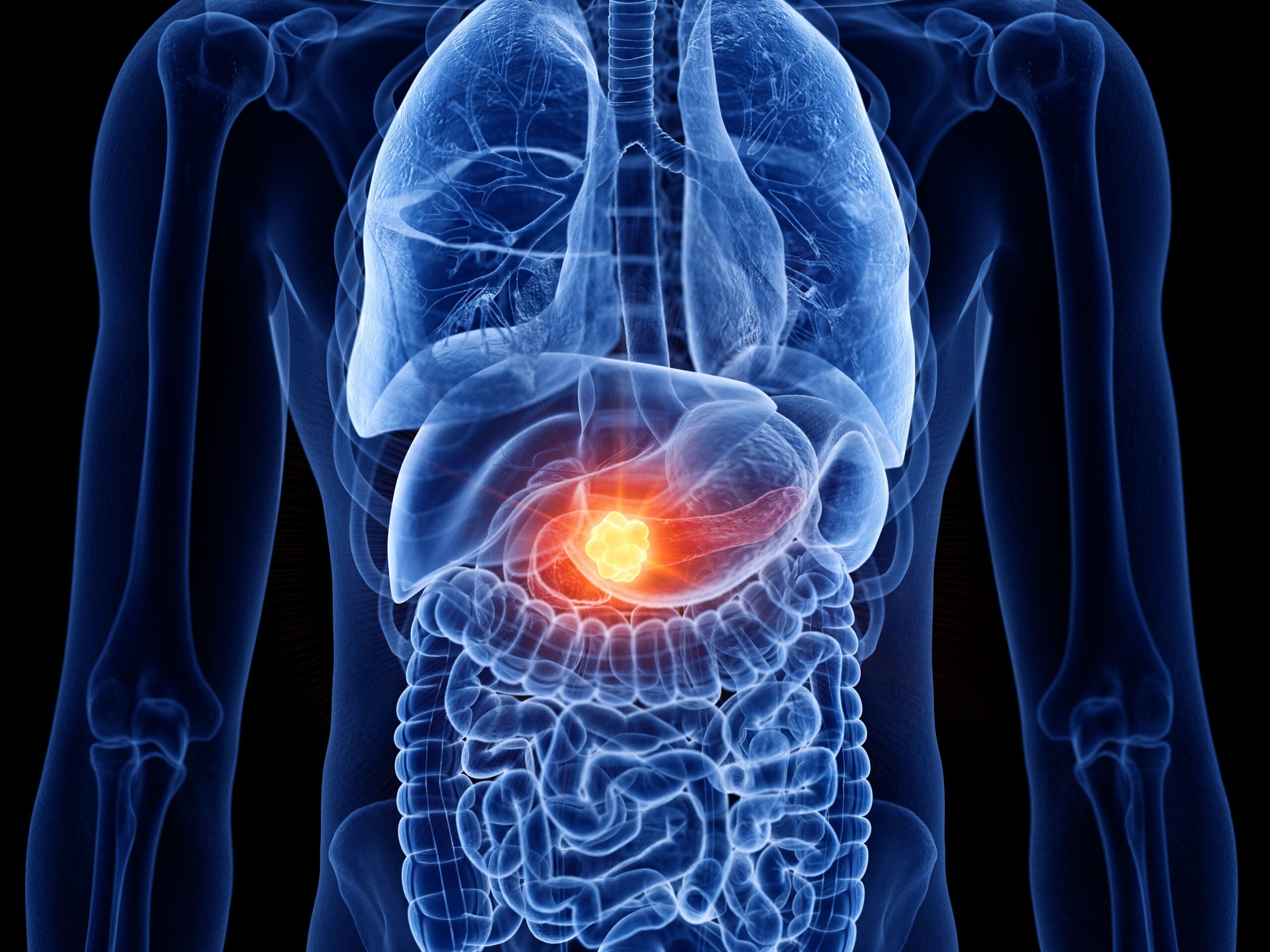 <![CDATA[Oxaliplatin as Part of Sequential Chemotherapy Shows Promise in Metastatic Pancreatic Cancer]]>