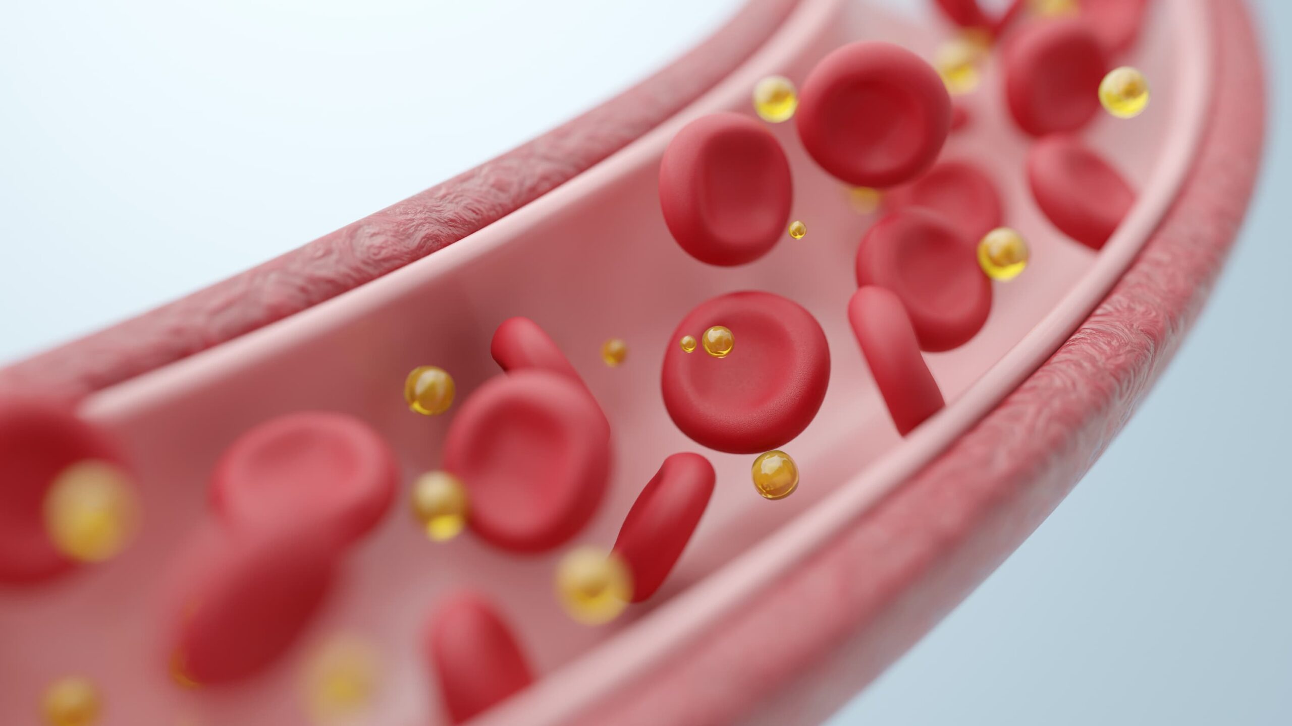 <![CDATA[Hyperlipidemia Causally Linked to Increased Risk of Alzheimer Disease]]>