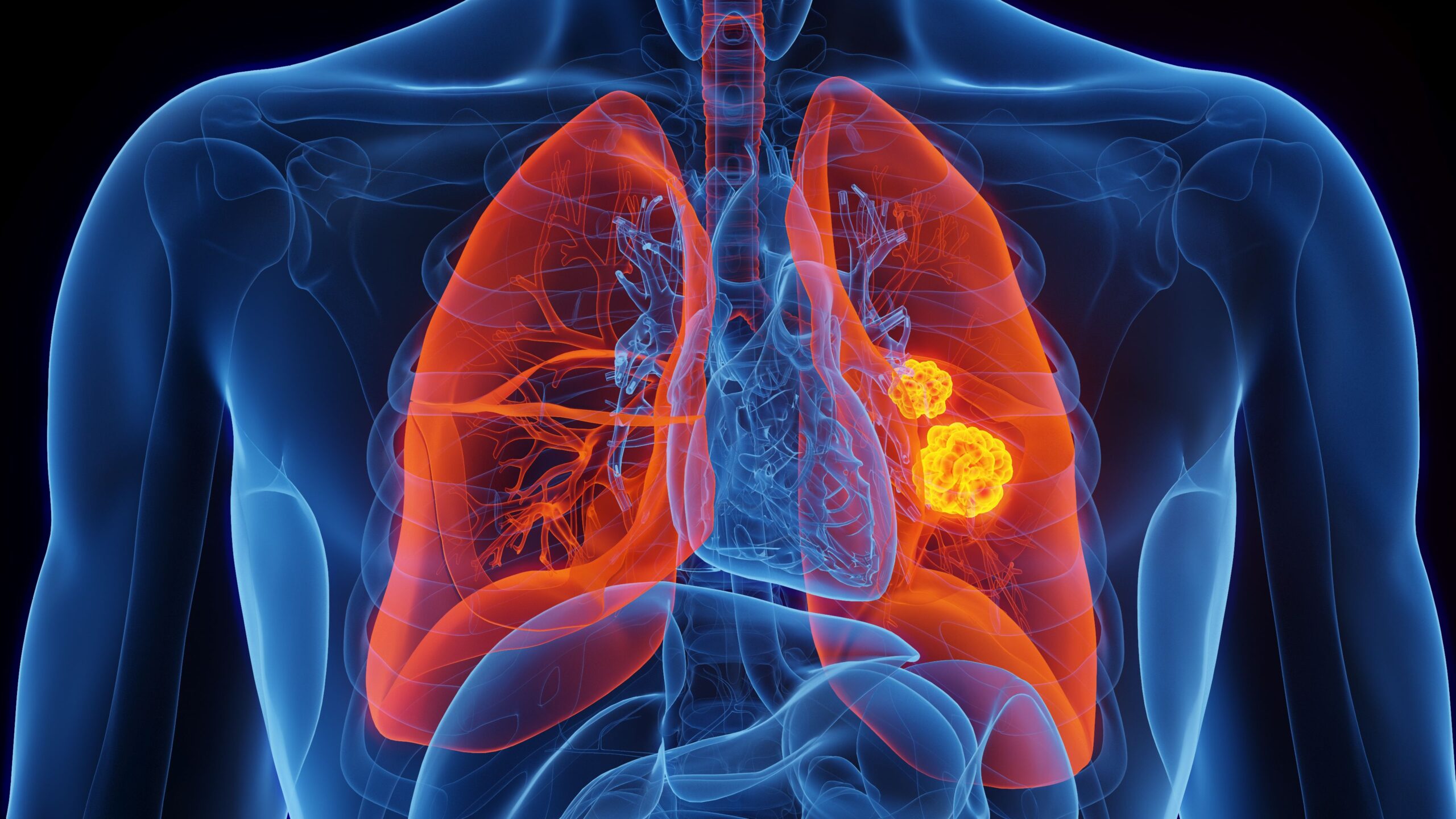 <![CDATA[KEYNOTE Trial Data Presented at ESMO 2025 Congress Reiterate Pembrolizumab’s Benefits in NSCLC]]>