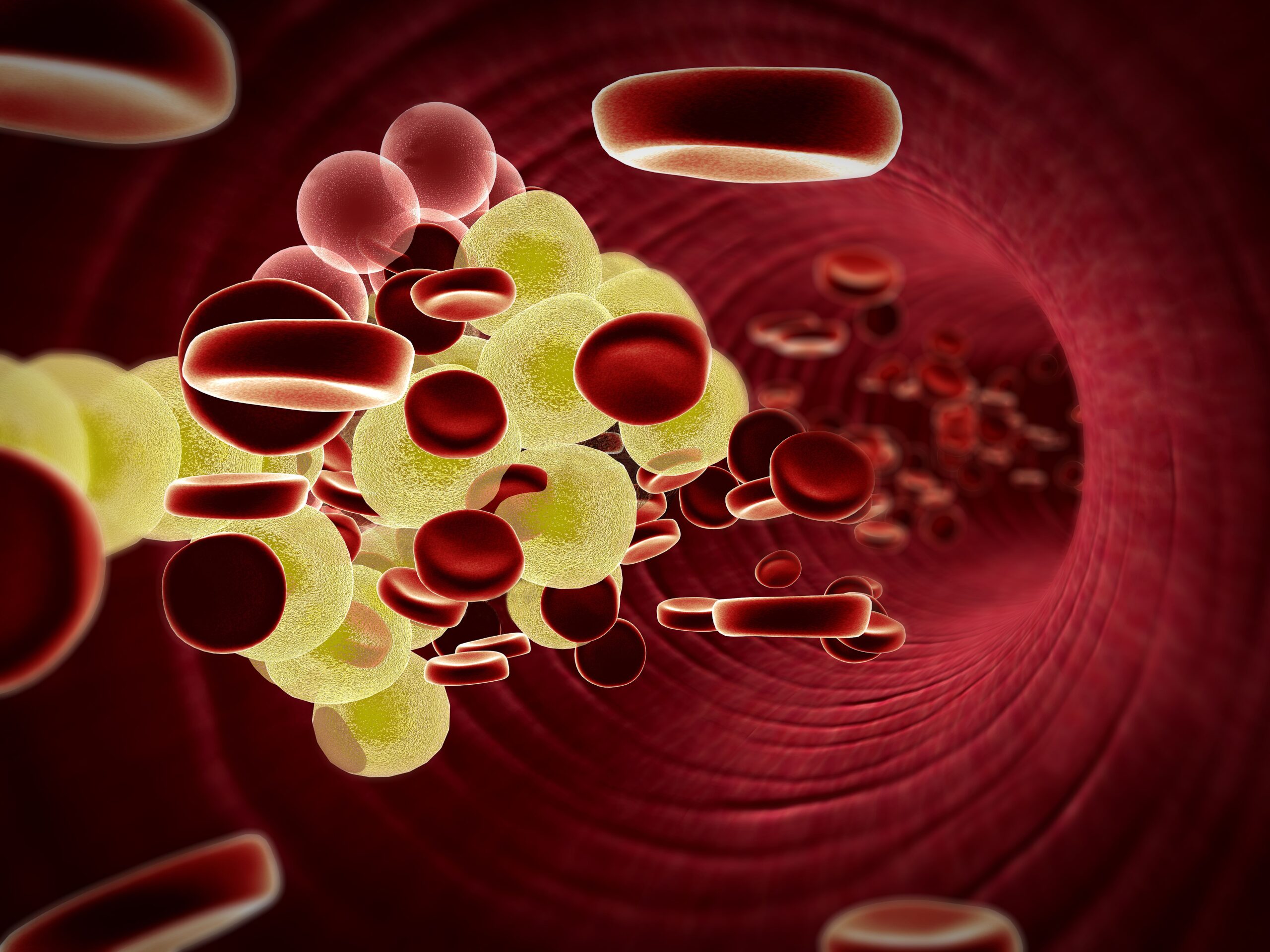 <![CDATA[Population Genomic Screening Improves Lipid Management in Familial Hypercholesterolemia]]>