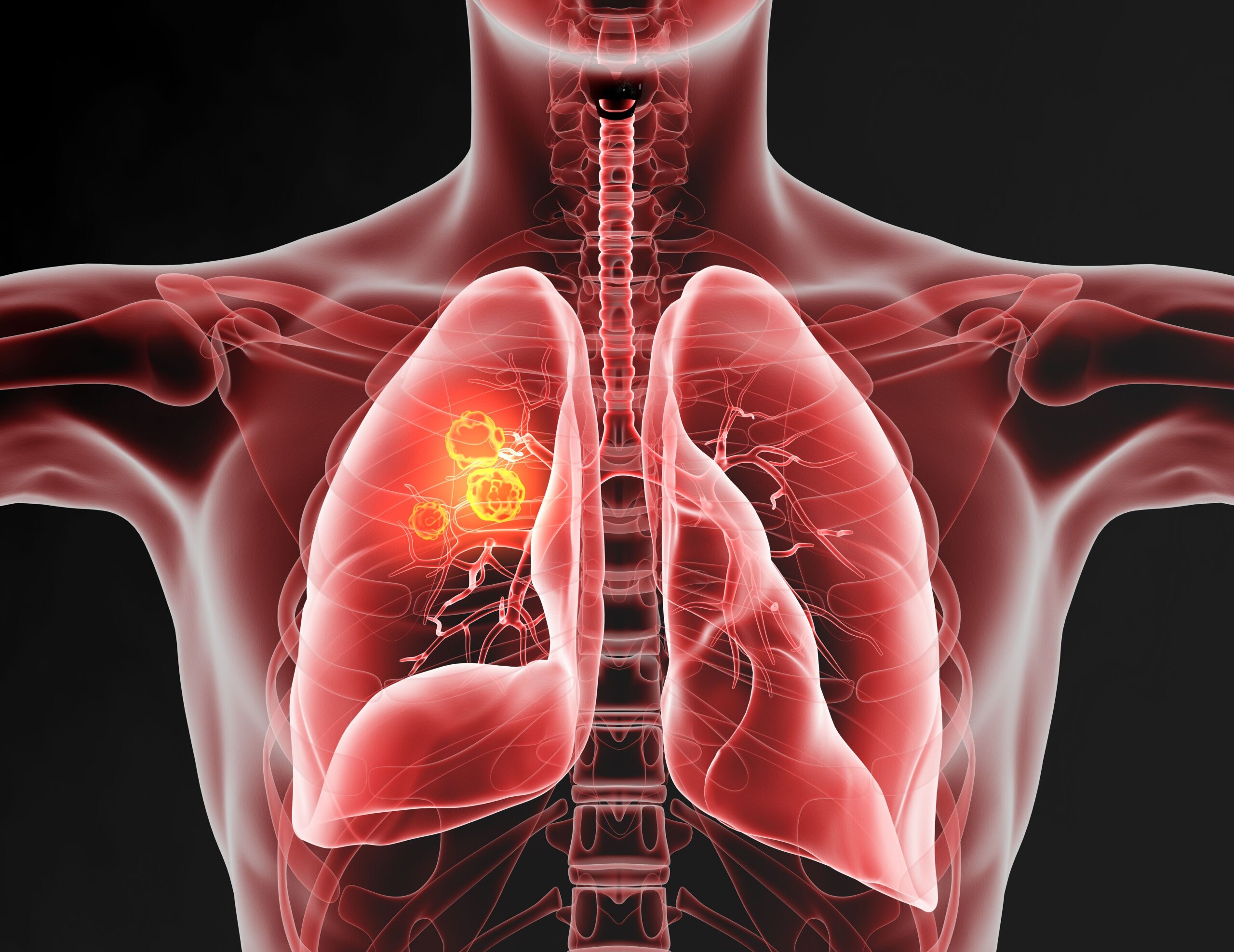 <![CDATA[Zongertinib Shows Clinically Meaningful Efficacy in Advanced HER2-Mutant NSCLC]]>