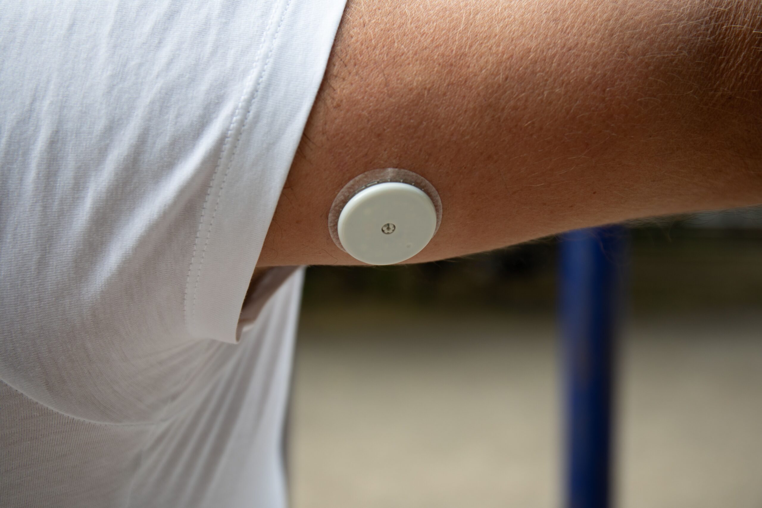 <![CDATA[CGM-Based Assessment of Factors Linked to Abnormal Glycemic Variability in T2D]]>