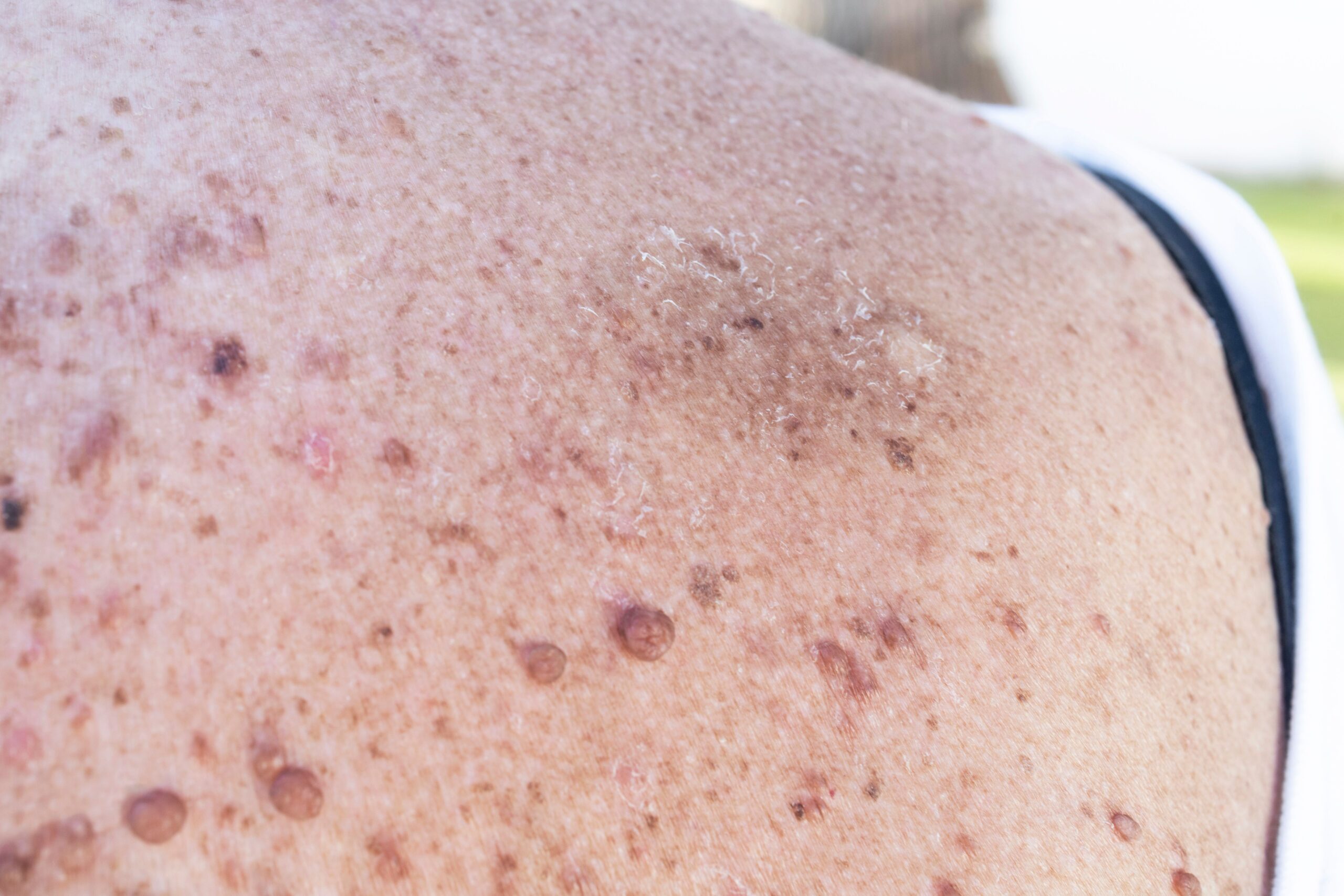<![CDATA[Selumetinib Is Approved for Adults With Neurofibromatosis Type 1 With Plexiform Neurofibromas]]>