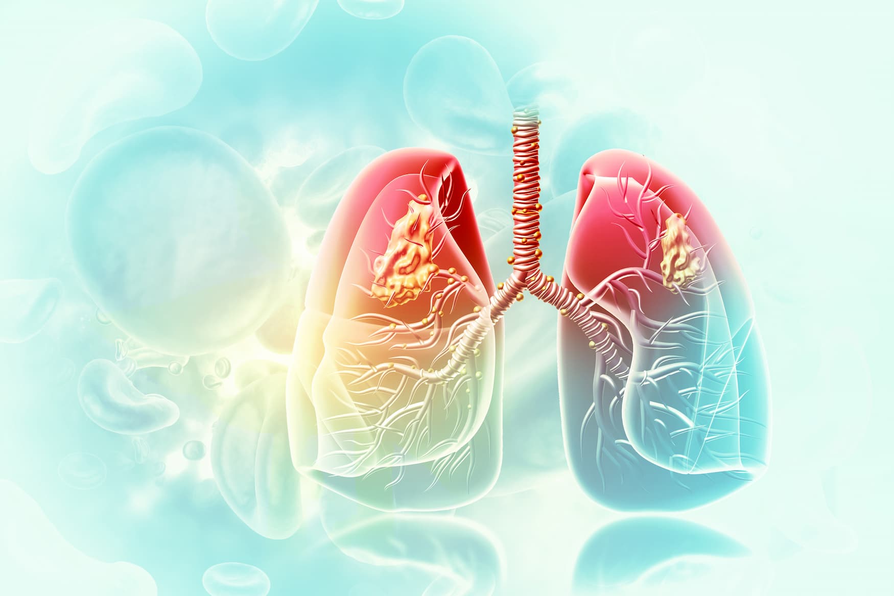 <![CDATA[ FDA Approves Sevabertinib for HER2-Mutant Non-Small Cell Lung Cancer]]>