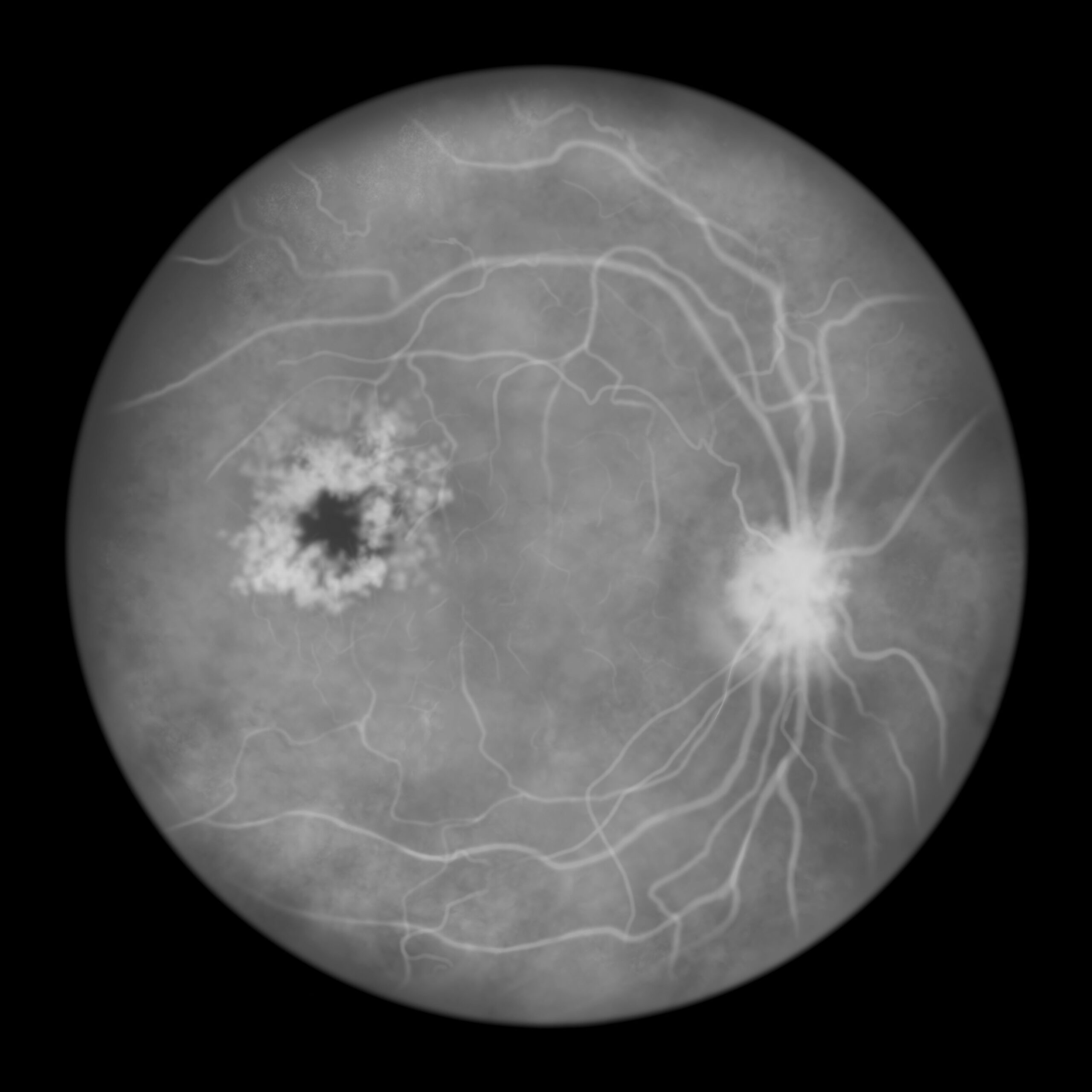 <![CDATA[FDA Approves Aflibercept Injection to Treat Patients With Macular Edema Following RVO]]>