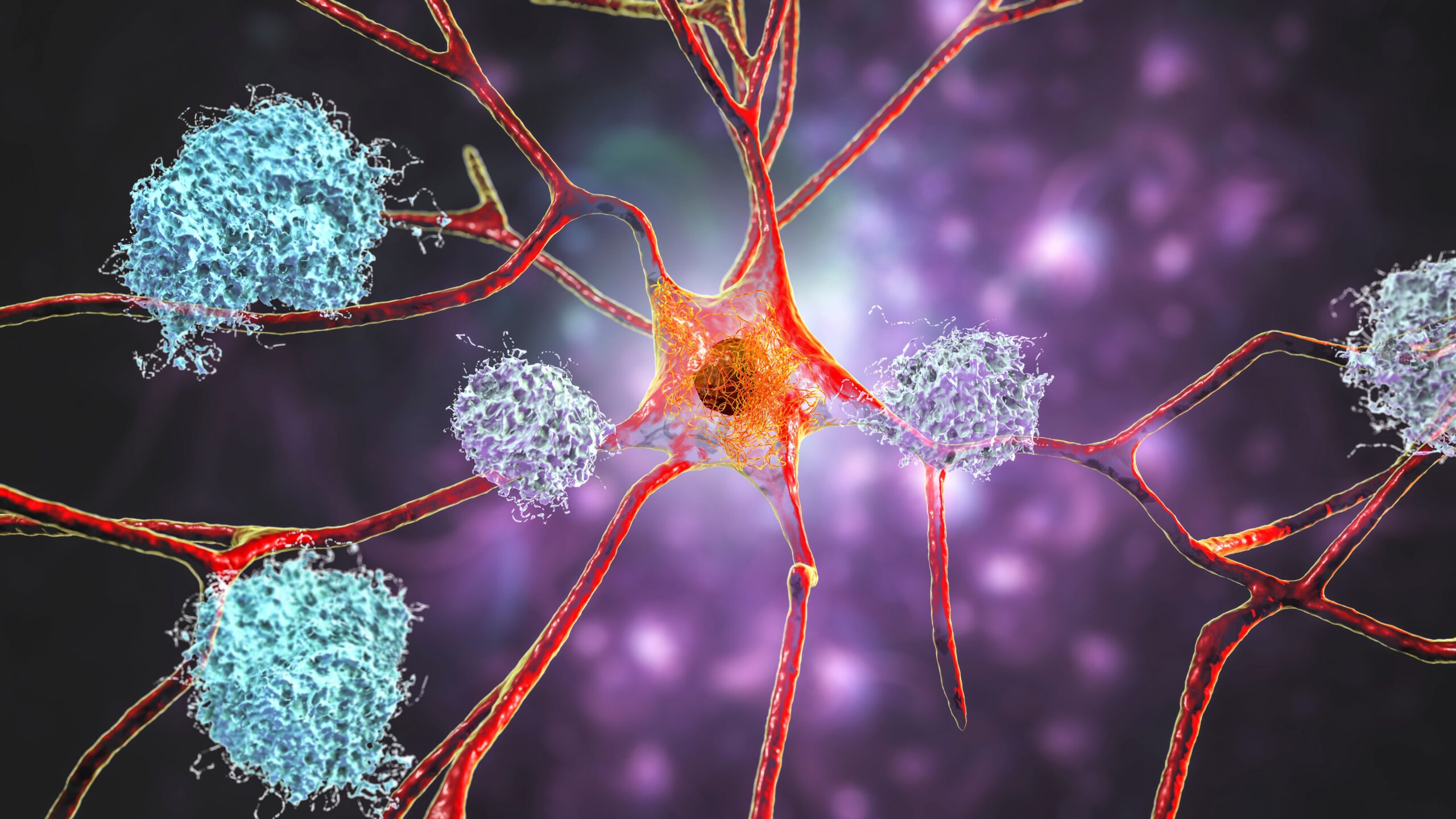 <![CDATA[Researchers Identify Key Lipid Pathways That Influence Alzheimer’s Progression]]>