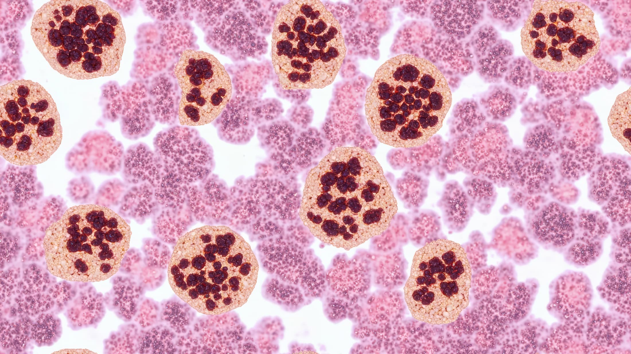 <![CDATA[Improving Outcomes in Diffuse B-Cell Lymphoma Requires Multidisciplinary Evolution]]>