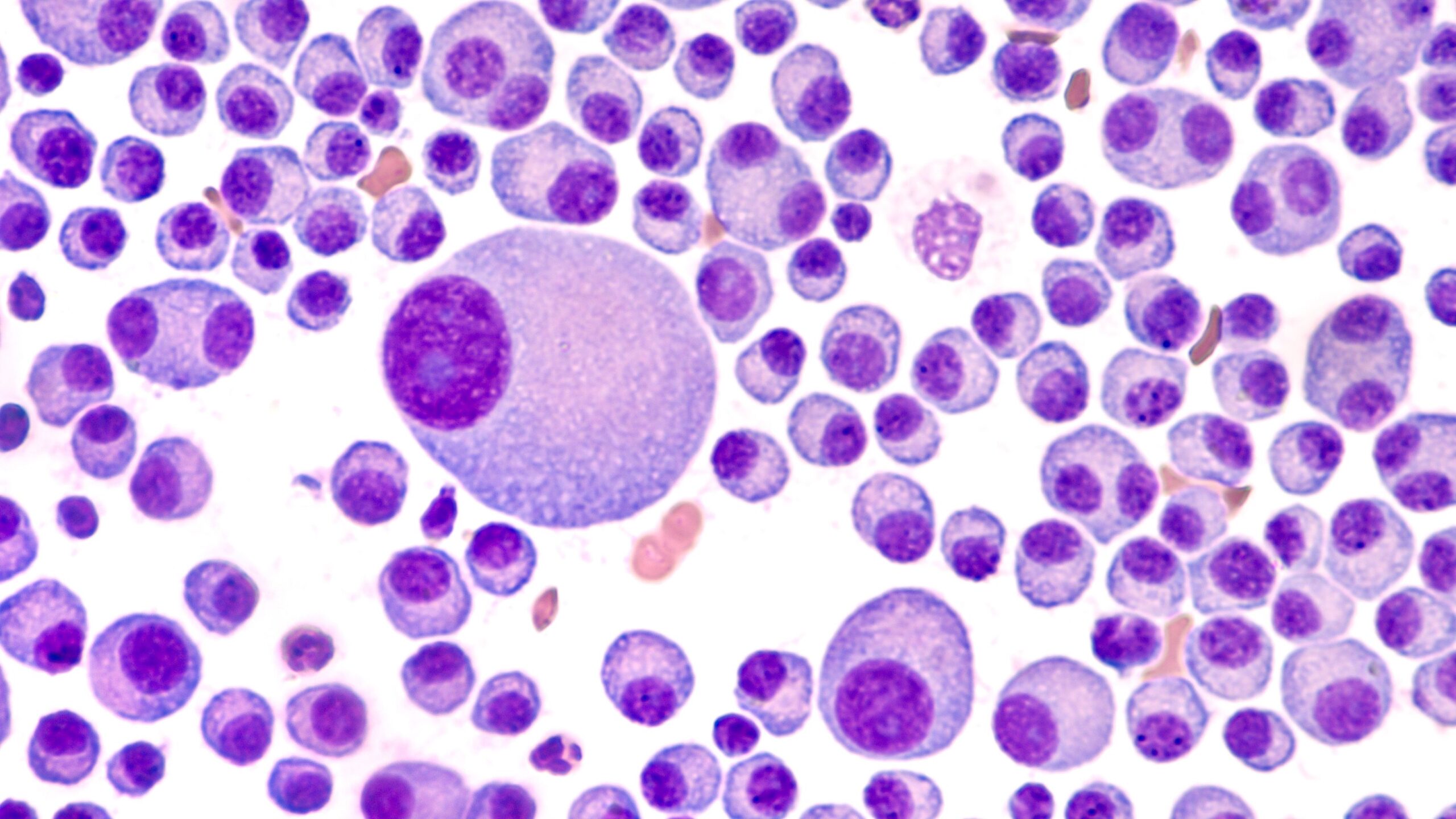 <![CDATA[Pharmacists Play a Critical Role in Managing Risk and Maximizing Outcomes Before Cilta-Cel]]>
