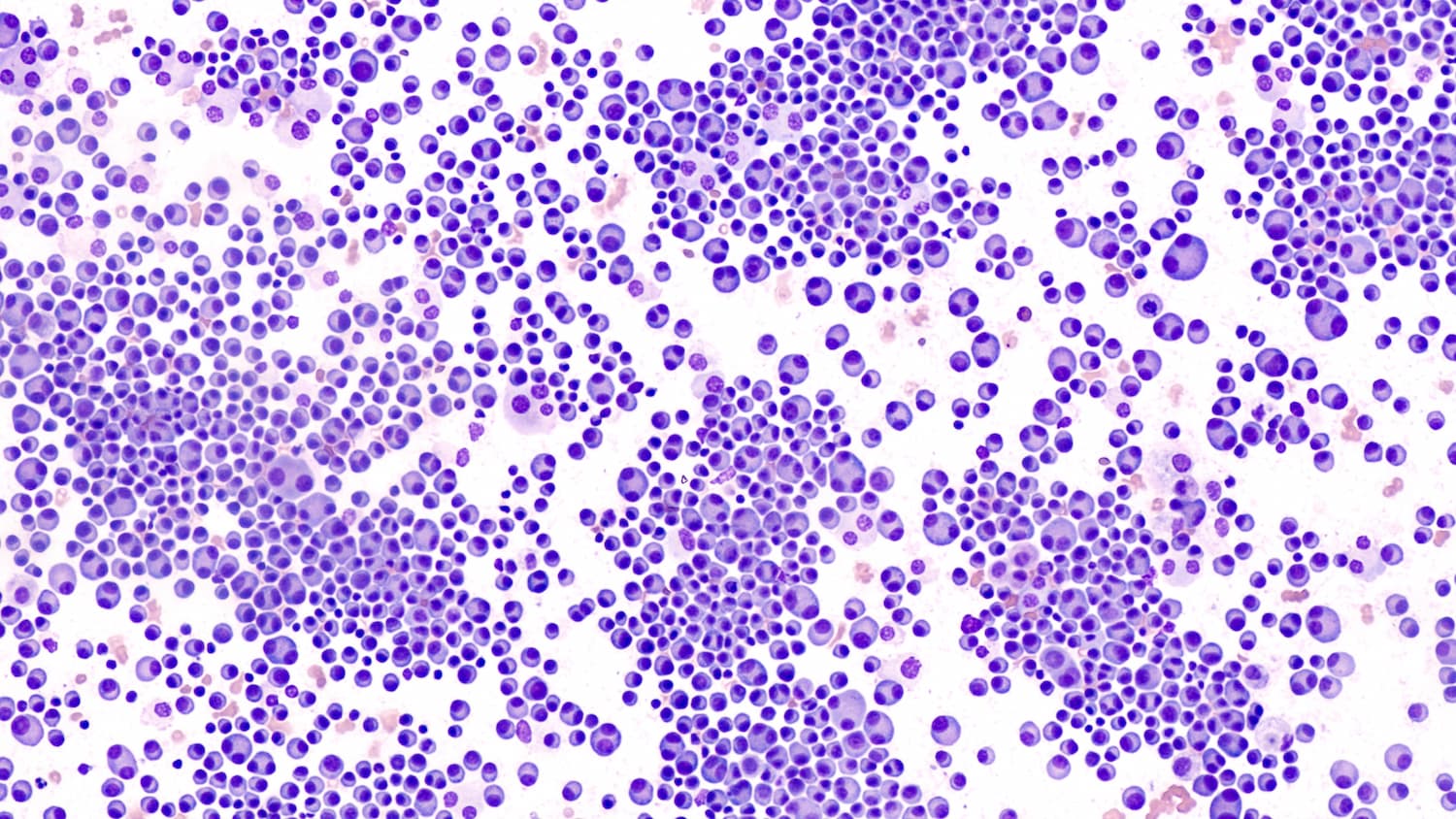 <![CDATA[Teclistamab-cqyv With Daratumumab and Hyaluronidase-fihj Improves Survival in Relapsed, Refractory MM]]>