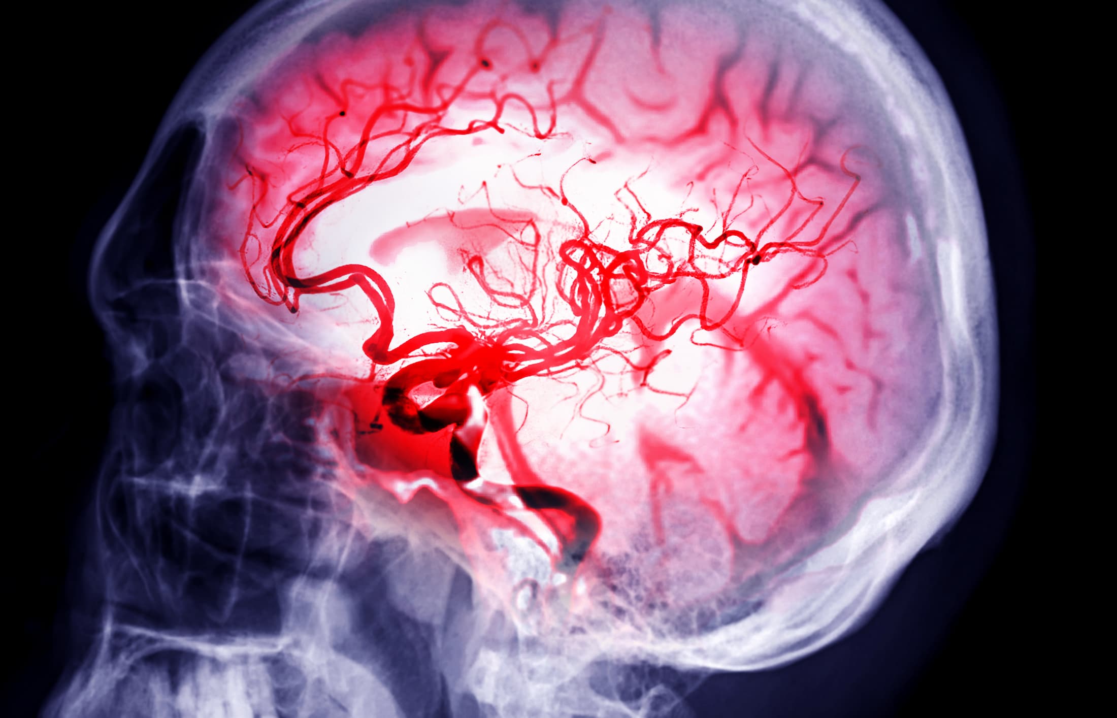 <![CDATA[Asundexian Reduces Risk of Future Ischemic Stroke as Secondary Prevention]]>