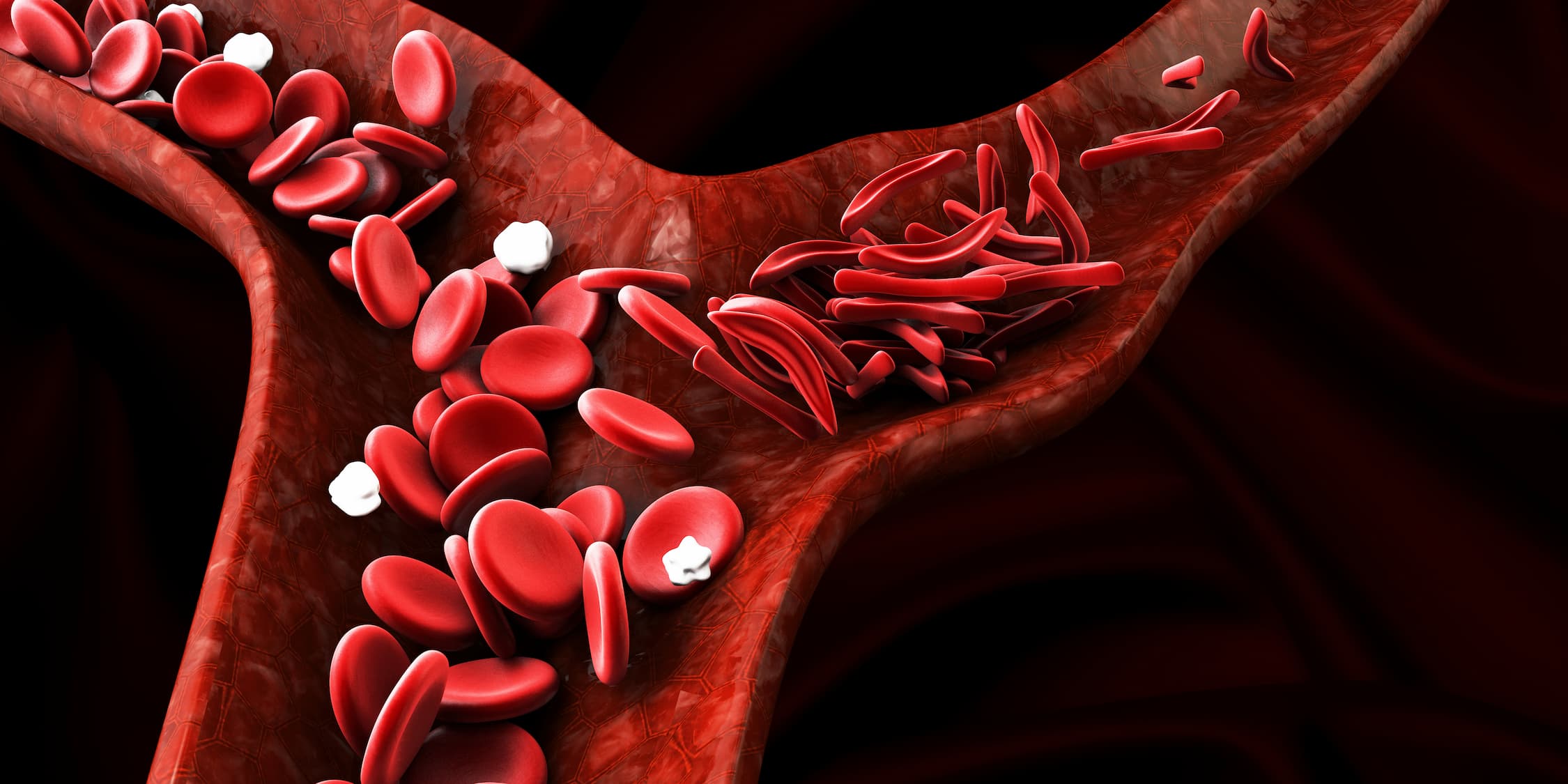 <![CDATA[Pneumococcal Booster Vaccination Is Necessary in Patients With Sickle Cell Disease]]>
