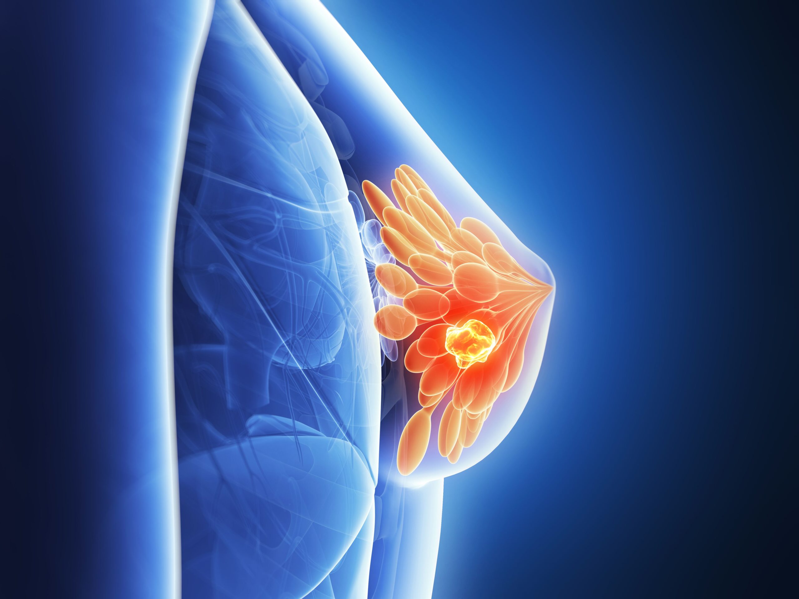 <![CDATA[FDA Approves T-DXd With Pertuzumab for First-Line Treatment of Advanced HER2+Breast Cancer]]>
