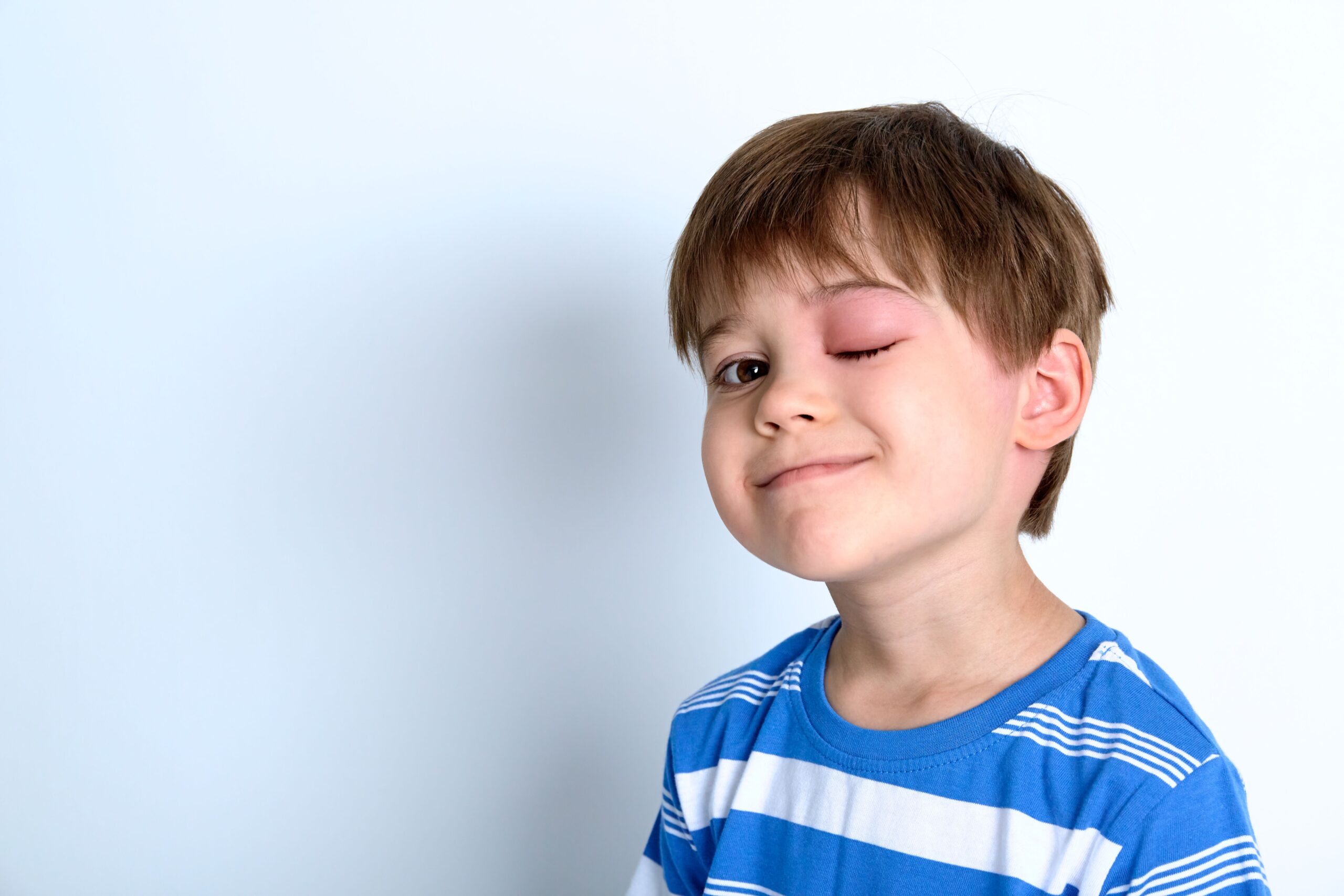 <![CDATA[Berotralstat Becomes First Oral Prophylactic for Pediatric Patients With Hereditary Angioedema]]>
