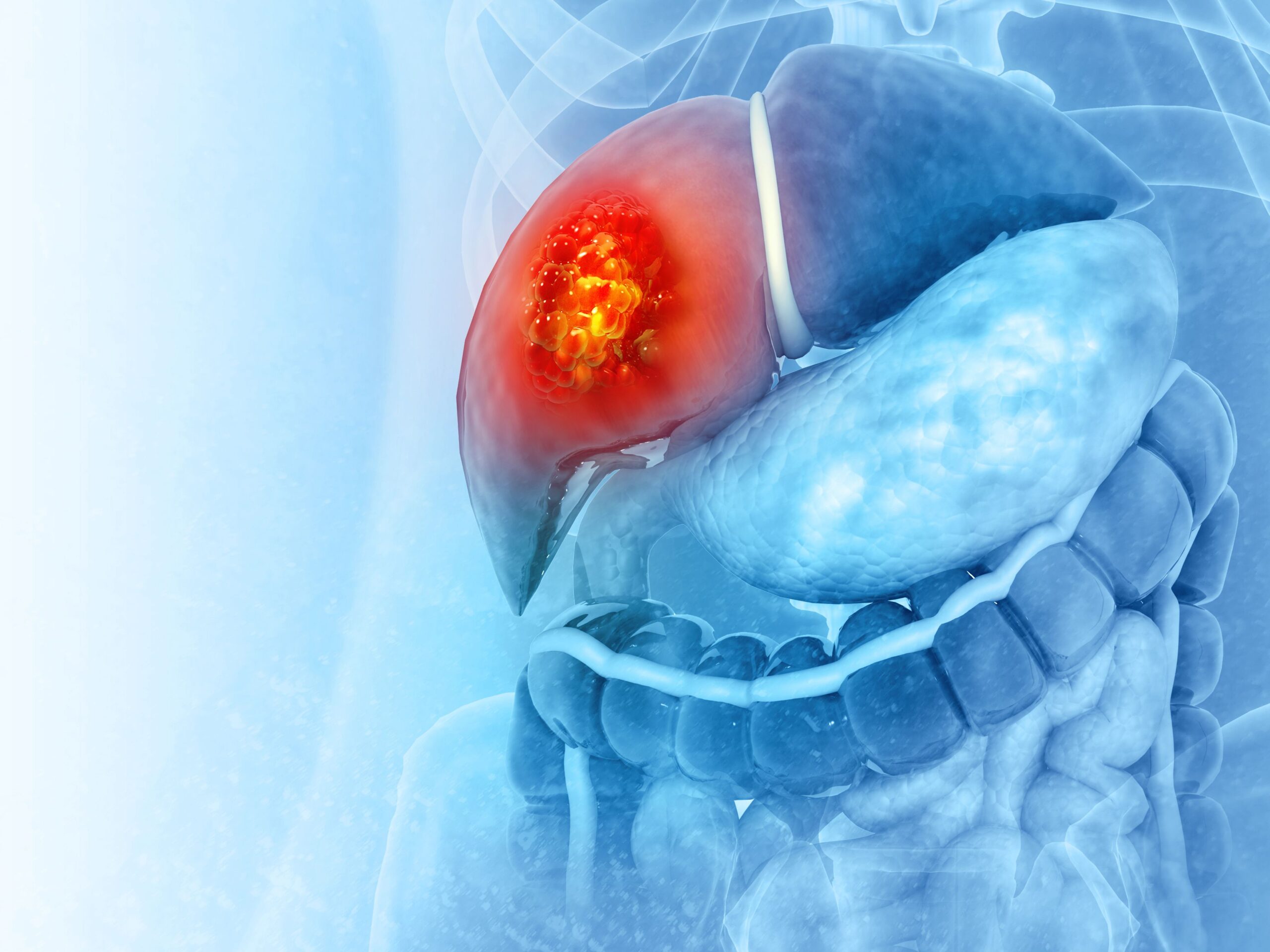 <![CDATA[Updates in Treatment of Unresectable Hepatocellular Carcinoma ]]>