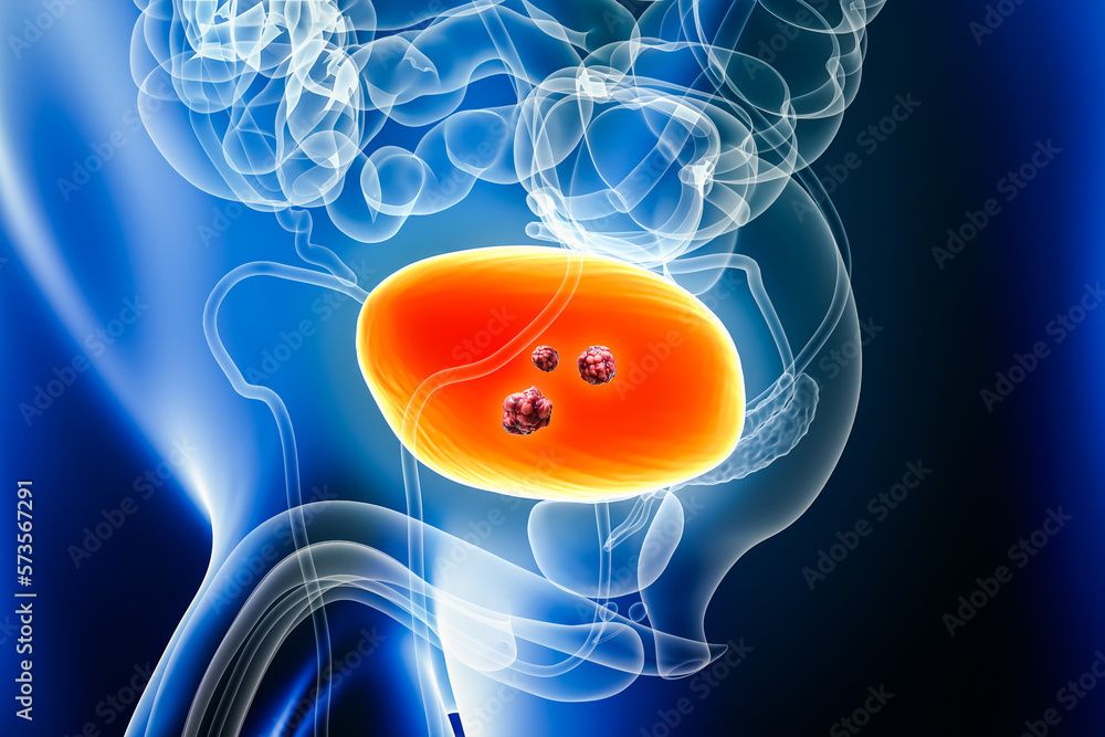 <![CDATA[Enfortumab Vedotin Plus Pembrolizumab Shows Promise as a Platinum-Free Option in Earlier Bladder Cancer]]>